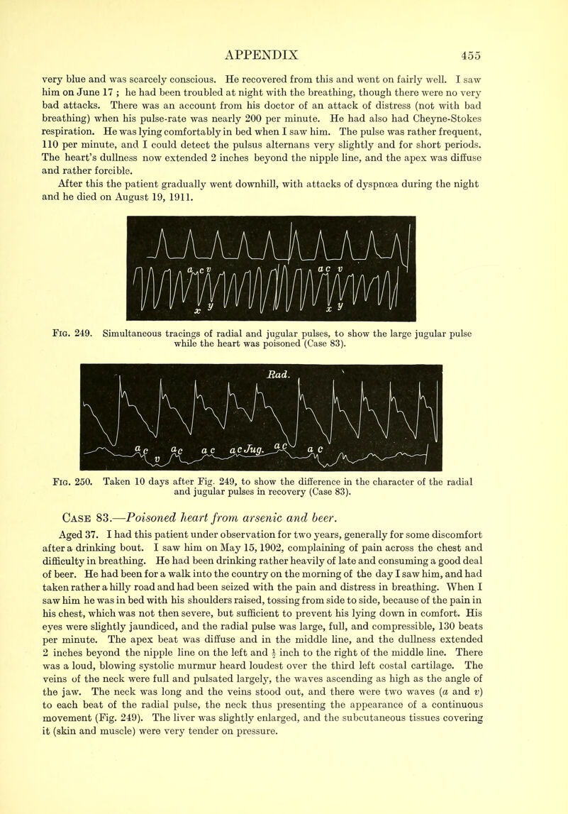 very blue and was scarcely conscious. He recovered from this and went on fairly well. I saw him on June 17 ; he had been troubled at night with the breathing, though there were no very bad attacks. There was an account from his doctor of an attack of distress (not with bad breathing) when his pulse-rate was nearly 200 per minute. He had also had Cheyne-Stokes respiration. He was lying comfortably in bed when I saw him. The pulse was rather frequent, 110 per minute, and I could detect the pulsus alternans very slightly and for short periods. The heart’s dullness now extended 2 inches beyond the nipple line, and the apex was diffuse and rather forcible. After this the patient gradually went downhill, with attacks of dyspnoea during the night and he died on August 19, 1911. Fig. 249. Simultaneous tracings of radial and jugular pulses, to show the large jugular pulse while the heart was poisoned (Case 83). Fig. 250. Taken 10 days after Fig. 249, to show the difference in the character of the radial and jugular pulses in recovery (Case 83). Case 83.—Poisoned heart from arsenic and beer. Aged 37. I had this patient under observation for two years, generally for some discomfort after a drinking bout. I saw him on May 15,1902, complaining of pain across the chest and difficulty in breathing. He had been drinking rather heavily of late and consuming a good deal of beer. He had been for a walk into the country on the morning of the day I saw him, and had taken rather a hilly road and had been seized with the pain and distress in breathing. When I saw him he was in bed with his shoulders raised, tossing from side to side, because of the pain in his chest, which was not then severe, but sufficient to prevent his lying down in comfort. His eyes were slightly jaundiced, and the radial pulse was large, full, and compressible, 130 beats per minute. The apex beat was diffuse and in the middle line, and the dullness extended 2 inches beyond the nipple line on the left and h inch to the right of the middle line. There was a loud, blowing systolic murmur heard loudest over the third left costal cartilage. The veins of the neck were full and pulsated largely, the waves ascending as high as the angle of the jaw. The neck was long and the veins stood out, and there were two waves (a and v) to each beat of the radial pulse, the neck thus presenting the appearance of a continuous movement (Fig. 249). The liver was slightly enlarged, and the subcutaneous tissues covering it (skin and muscle) were very tender on pressure.