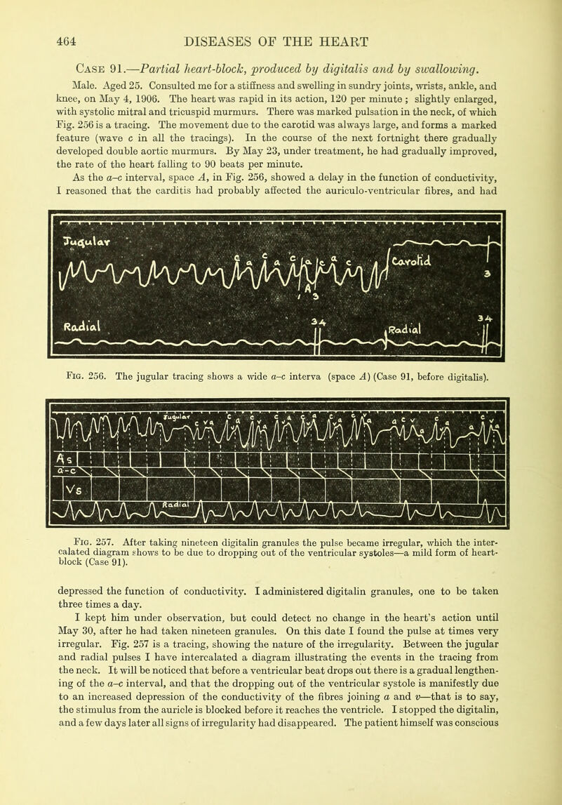 Case 91.—Partial heart-block, produced by digitalis and by swallowing. Male. Aged 25. Consulted me for a stiffness and swelling in sundry joints, wrists, ankle, and knee, on May 4, 1906. The heart was rapid in its action, 120 per minute ; slightly enlarged, with systolic mitral and tricuspid murmurs. There was marked pulsation in the neck, of which Fig. 256 is a tracing. The movement due to the carotid was always large, and forms a marked feature (wave c in all the tracings). In the course of the next fortnight there gradually developed double aortic murmurs. By May 23, under treatment, he had gradually improved, the rate of the heart falling to 90 beats per minute. As the a-c interval, space A, in Fig. 256, showed a delay in the function of conductivity, I reasoned that the carditis had probably affected the auriculo-ventricular fibres, and had Fig. 256. The jugular tracing shows a wide a-c interva (space A) (Case 91, before digitalis). Fig. 257. After taking nineteen digitalin granules the pulse became irregular, which the inter- calated diagram shows to be due to dropping out of the ventricular systoles—a mild form of heart- block (Case 91). depressed the function of conductivity. I administered digitalin granules, one to be taken three times a day. I kept him under observation, but could detect no change in the heart’s action until May 30, after he had taken nineteen granules. On this date I found the pulse at times very irregular. Fig. 257 is a tracing, showing the nature of the irregularity. Between the jugular and radial pulses I have intercalated a diagram illustrating the events in the tracing from the neck. It will be noticed that before a ventricular beat drops out there is a gradual lengthen- ing of the a-c interval, and that the dropping out of the ventricular systole is manifestly due to an increased depression of the conductivity of the fibres joining a and v—that is to say, the stimulus from the auricle is blocked before it reaches the ventricle. I stopped the digitalin, and a few days later all signs of irregularity had disappeared. The patient himself was conscious