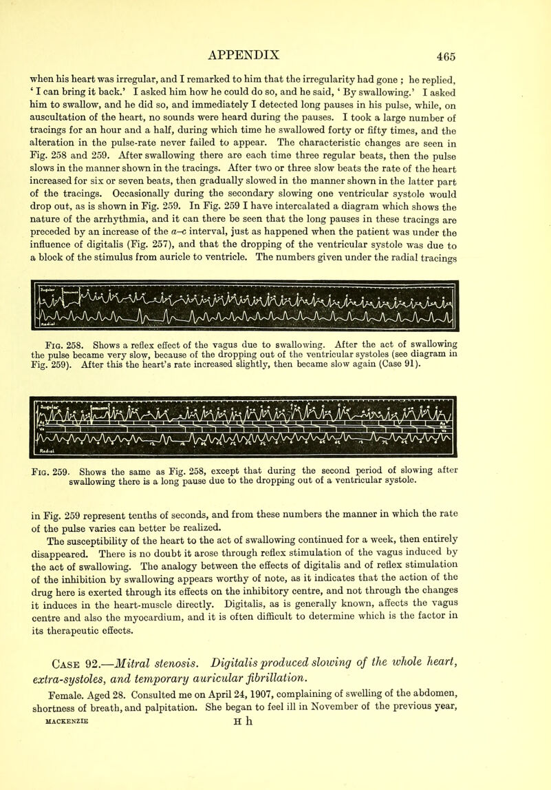 when his heart was irregular, and I remarked to him that the irregularity had gone ; he replied, ‘ I can bring it back.’ I asked him how he could do so, and he said, ‘ By swallowing.’ I asked him to swallow, and he did so, and immediately I detected long pauses in his pulse, while, on auscultation of the heart, no sounds were heard during the pauses. I took a large number of tracings for an hour and a half, during which time he swallowed forty or fifty times, and the alteration in the pulse-rate never failed to appear. The characteristic changes are seen in Fig. 258 and 259. After swallowing there are each time three regular beats, then the pulse slows in the manner shown in the tracings. After two or three slow beats the rate of the heart increased for six or seven beats, then gradually slowed in the manner shown in the latter part of the tracings. Occasionally during the secondary slowing one ventricular systole would drop out, as is shown in Fig. 259. In Fig. 259 I have intercalated a diagram which shows the nature of the arrhythmia, and it can there be seen that the long pauses in these tracings are preceded by an increase of the a-c interval, just as happened when the patient was under the influence of digitalis (Fig. 257), and that the dropping of the ventricular systole was due to a block of the stimulus from auricle to ventricle. The numbers given under the radial tracings Fig. 258. Shows a reflex effect of the vagus due to swallowing. After the act of swallowing the pulse became very slow, because of the dropping out of the ventricular systoles (see diagram in Fig. 259). After this the heart’s rate increased slightly, then became slow again (Case 91). Fig. 259 i. Shows the same as Fig. 258, except that during the second period of slowing after swallowing there is a long pause due to the dropping out of a ventricular systole. in Fig. 259 represent tenths of seconds, and from these numbers the manner in which the rate of the pulse varies can better be realized. The susceptibility of the heart to the act of swallowing continued for a week, then entirely disappeared. There is no doubt it arose through reflex stimulation of the vagus induced by the act of swallowing. The analogy between the effects of digitalis and of reflex stimulation of the inhibition by swallowing appears worthy of note, as it indicates that the action of the drug here is exerted through its efiects on the inhibitory centre, and not through the changes it induces in the heart-muscle directly. Digitalis, as is generally known, affects the vagus centre and also the myocardium, and it is often difficult to determine which is the factor in its therapeutic efEects. Case 92.—Mitral stenosis. Digitalis produced slowing of the whole heart, extra-systoles, and temporary auricular fibrillation. Female. Aged 28. Consulted me on April 24,1907, complaining of swelling of the abdomen, shortness of breath, and palpitation. She began to feel ill in November of the previous year, MACKENZIE H h