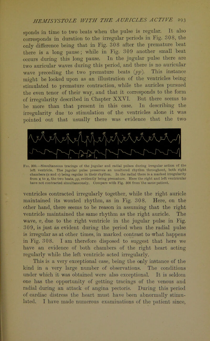sponds in time to two beats when the pulse is regular. It also corresponds in duration to the irregular periods in Fig. 308, the only difference being that in Fig. 308 after the premature beat there is a long pause; while in Fig. 309 another small beat occurs during this long pause. In the jugular pulse there are two auricular waves during this period, and there is no auricular wave preceding the two premature beats (jop). This instance might be looked upon as an illustration of the ventricles being stimulated to premature contraction, while the auricles pursued the even tenor of their way, and that it corresponds to the form of irregularity described in Chapter XXVI. But there seems to be more than that present in this case. In describing the irregularity due to stimulation of the ventricles alone it was pointed out that usually there was evidence that the two F10. 309.—Simultaneous tracings of the jugular and radial pulses during irregular action of the left ventricle. The jugular pulse preserves an unaltered rhythm throughout, both right chambers (a and v) being regular in their rhythm. In the radial there is a marked irregularity from x to x, the two beats, pp, evidently being premature. Here the right and left ventricular have not contracted simultaneously. Compare with Fig. 308 from the same patient. ventricles contracted irregularly together, while the right auricle maintained its wonted rhythm, as in Fig. 308. Here, on the other hand, there seems to be reason in assuming that the right ventricle maintained the same rhythm as the right auricle. The wave, v, due to the right ventricle in the jugular pulse in Fig. 309, is just as evident during the period when the radial pulse is irregular as at other times, in marked contrast to what happens in Fig. 308. I am therefore disposed to suggest that here we have an evidence of both chambers of the right heart acting regularly while the left ventricle acted irregularly. This is a very exceptional case, being the only instance of the kind in a very large number of observations. The conditions under which it was obtained were also exceptional. It is seldom one has the opportunity of getting tracings of the venous and radial during an attack of angina pectoris. During this period of cardiac distress the heart must have been abnormally stimu- lated. I have made numerous examinations of the patient since,