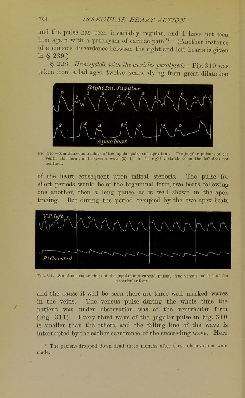 and the pulse has been invariably regular, and I have not seen him again with a paroxysm of cardiac pain.* (Another instance of a curious discordance between the right and left hearts is cdven in § 239.) § 228. Hemisy stole with the auricles paralysed.—Fig. 310 was taken from a lad aged twelve years, dying from great dilatation r 2 MightInt. Jugular 12 12 1 2 A 2 /S ' AAAVV t{ A l\ A AAA A aA J V - —' Vj V Vj v—— Apex beat Fig 310.—Simultaneous tracings of the jugular pulse anti apex beat. The jugular pulse is of the ventricular form, anti shows a wave (3) due to the right ventricle when the lea does not contract. of the heart consequent upon mitral stenosis. The pulse for short periods would he of the bigeminal form, two beats following one another, then a long pause, as is well shown in the apex tracing. But during the period occupied by the two apex beats Fio. 311.—Simultaneous tracings of the jugular and carotid pulses. The venous pulso is of the ventricular form. and the pause it will be seen there are three well marked waves in the veins. The venous pulse during the whole time the patient was under observation was of the ventricular form (Fig. 311). Every third wave of the jugular pulse in Fig. 310 is smaller than the others, and the falling line of the wave is interrupted by the earlier occurrence of the succeeding wave. Here * The patient dropped down dead three months after these observations were made.