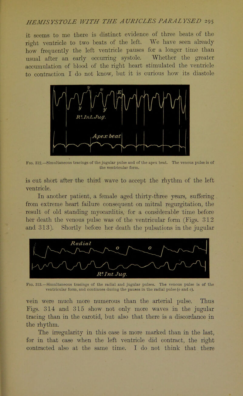 it seems to me there is distinct evidence of three beats of the right ventricle to two heats of the left. We have seen already how frequently the left ventricle pauses for a longer time than usual after an early occurring systole. Whether the greater accumulation of blood of the right heart stimulated the ventricle to contraction I do not know, but it is curious how its diastole Fio. 312.—Simultaneous tracings of the jugular pulse and of the apex beat. The venous pulse is of the ventricular form. is cut short after the third wave to accept the rhythm of the left ventricle. In another patient, a female aged thirty-three years, suffering from extreme heart failure consequent on mitral regurgitation, the result of old standing myocarditis, for a considerable time before her death the venous pulse was of the ventricular form (Figs. 312 and 313). Shortly before her death the pulsations in the jugular Fio. 313.—Simultaneous tracings of the radial and jugular pulses. The venous pulse is of the ventricular form, and continues during the pauses in the radial pulse (o and o). vein were much more numerous than the arterial pulse. Thus Figs. 314 and 315 show not only more waves in the jugular tracing than in the carotid, but also that there is a discordance in the rhythm. The irregularity in this case is more marked than in the last, for in that case when the left ventricle did contract, the right contracted also at the same time. I do not think that there