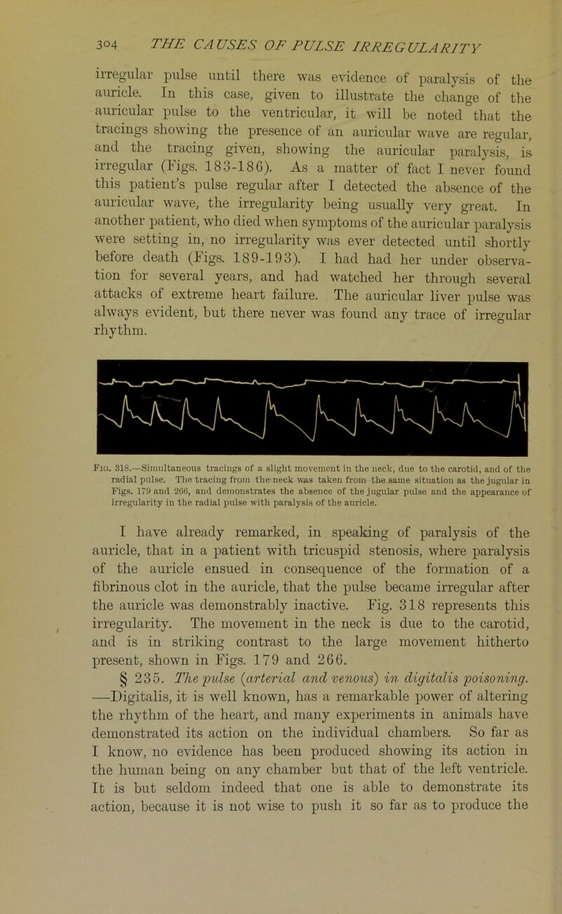 iiregular pulse until there was evidence of paralysis of the auricle. In this case, given to illustrate the change of the auricular pulse to the ventricular, it will be noted that the tracings showing the presence of an auricular wave are regular, and the tracing given, showing the auricular paralysis, is irregular (Figs. 183-186). As a matter of fact I never found this patient’s pulse regular after I detected the absence of the auricular wave, the irregularity being usually very great. In another patient, who died when symptoms of the auricular paralysis were setting in, no irregularity was ever detected until shortly before death (ligs. 1S9-193). I had had her under observa- tion for several years, and had watched her through several attacks of extreme heart failure. The auricular liver pulse was always evident, but there never was found any trace of irregular rhythm. Fig. 318.—Simultaneous tracings of a slight movement in the neck, due to the carotid, and of the radial pulse. The tracing from the neck was taken from the same situation as the jugular in Figs. 179 and 200, and demonstrates the absence of the jugular pulse and the appearance of irregularity in the radial pulse with paralysis of the auricle. I have already remarked, in speaking of paralysis of the auricle, that in a patient with tricuspid stenosis, where paralysis of the auricle ensued in consequence of the formation of a fibrinous clot in the auricle, that the pulse became irregular after the auricle was demonstrably inactive. Fig. 318 represents this irregularity. The movement in the neck is due to the carotid, and is in striking contrast to the large movement hitherto present, shown in Figs. 179 and 266. § 235. The pulse (arterial ancl venous) in digitalis 'poisoning. —Digitalis, it is well known, has a remarkable power of altering the rhythm of the heart, and many experiments in animals have demonstrated its action on the individual chambers. So far as I know, no evidence has been produced showing its action in the human being on any chamber but that of the left ventricle. It is but seldom indeed that one is able to demonstrate its action, because it is not wise to push it so far as to produce the