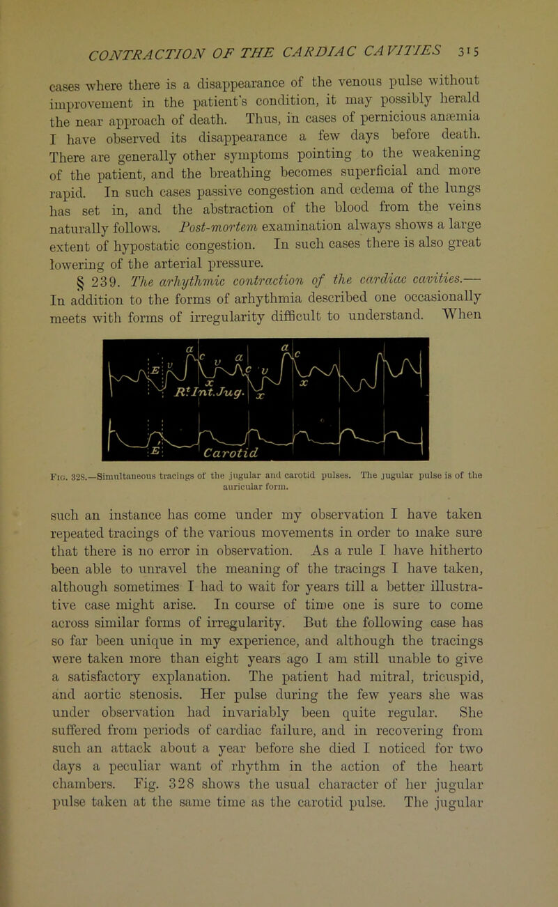 cases where there is a disappearance of the venous pulse without improvement in the patient s condition, it may possibl) herald the near approach of death. Thus, in cases of pernicious anaemia I have observed its disappearance a few days before death. There are generally other symptoms pointing to the weakening of the patient, and the breathing becomes superficial and more rapid. In such cases passive congestion and oedema of the lungs has set in, and the abstraction of the blood from the veins naturally follows. Post-mortem examination always shows a large extent of hypostatic congestion. In such cases there is also great lowering of the arterial pressure. § 239. The arhythmic contraction of the cardiac cavities.— In addition to the forms of arhythmia described one occasionally meets with forms of irregularity difficult to understand. When Fto. 32s.—Simultaneous tracings of tlie jugular and carotid pulses. The jugular pulse is of the auricular form. such an instance has come under my observation I have taken repeated tracings of the various movements in order to make sure that there is no error in observation. As a rule I have hitherto been able to unravel the meaning of the tracings I have taken, although sometimes I had to wait for years till a better illustra- tive case might arise. In course of time one is sure to come across similar forms of irregularity. But the following case has so far been unicpie in my experience, and although the tracings were taken more than eight years ago I am still unable to give a satisfactory explanation. The patient had mitral, tricuspid, and aortic stenosis. Her pulse during the few years she was under observation had invariably been quite regular. She suffered from periods of cardiac failure, and in recovering from such an attack about a year before she died I noticed for two days a peculiar want of rhythm in the action of the heart chambers. Big. 328 shows the usual character of her jugular pulse taken at the same time as the carotid pulse. The jugular
