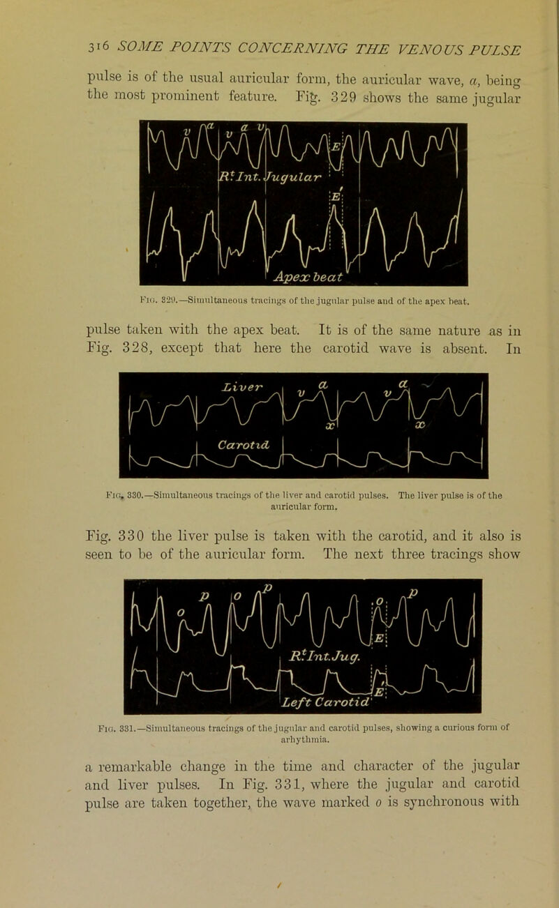 pulse is of the usual auricular form, the auricular wave, a, being the most prominent feature. Fig. 329 shows the same jugular Flo. 320.—Simultaneous tracings of the jugular pulse and of the apex beat. pulse taken with the apex beat. It is of the same nature as in Fig. 328, except that here the carotid wave is absent. In Fic:. 330.—Simultaneous tracings of the liver and carotid pulses. The liver pulse is of the auricular form. Fig. 330 the liver pulse is taken with the carotid, and it also is seen to be of the auricular form. The next three tracings show Fig. 331.—Simultaneous tracings of the jugular and carotid pulses, showing a curious form of arhythmia. a remarkable change in the time and character of the jugular and liver pulses. In Fig. 331, where the jugular and carotid pulse are taken together, the wave marked o is s)7nchronous with