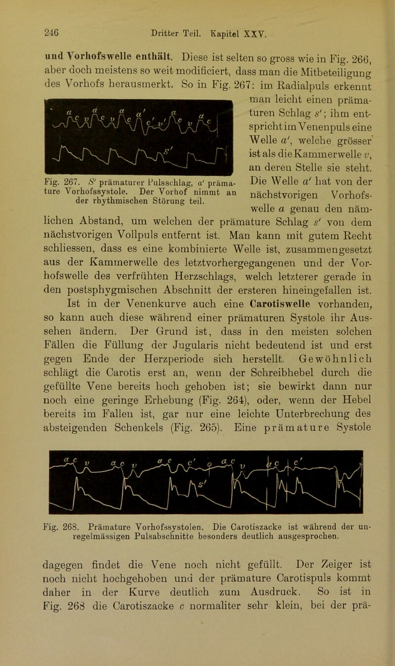Ä 2 a' a 1 rvj'f Fig. 267. S‘ prämaturer Fulssehlag, a‘ präma- ture Vorhofssystole. Der Vorhof nimmt an der rhythmischen Störung teil. und Vorhofswelle enthält. Diese ist selten so gross wie in Fig. 266, aber doch meistens so weit modificiert, dass man die Mitbeteiligung des Vorhofs herausmerkt. So in Fig. 267: im Radialpuls erkennt man leicht einen präma- turen Schlag sihm ent- spricht i m V enenpuls eine Welle a\ welche grösser ist als die Kammerwelle v, an deren Stelle sie steht. Die Welle a' hat von der nächstvorigen Vorhofs- welle a genau den näm- lichen Abstand, um welchen der prämature Schlag s' von dem nächstvorigen Vollpuls entfernt ist. Man kann mit gutem Recht schliessen, dass es eine kombinierte Welle ist, zusammengesetzt aus der Kammerwelle des letztvorhergegangenen und der Vor- hofswelle des verfrühten Herzschlags, welch letzterer gerade in den postsphvgmischen Abschnitt der ersteren hineingefallen ist. Ist in der Venenkurve auch eine Carotiswelle vorhanden, so kann auch diese während einer prämaturen Systole ihr Aus- sehen ändern. Der Grund ist, dass in den meisten solchen Fällen die Füllung der Jugularis nicht bedeutend ist und erst gegen Ende der Herzperiode sich herstellt. Gewöhnlich schlägt die Carotis erst an, wenn der Schreibhebel durch die gefüllte Vene bereits hoch gehoben ist; sie bewirkt dann nur noch eine geringe Erhebung (Fig. 264), oder, wenn der Hebel bereits im Fallen ist, gar nur eine leichte Unterbrechung des absteigenden Schenkels (Fig. 265). Eine prämature Systole Fig. 268. Prämature Vorhofssystolen. Die Carotiszacke ist während der un- regelmässigen Pulsabschnitte besonders deutlich ausgesprochen. dagegen findet die Vene noch nicht gefüllt. Der Zeiger ist noch nicht hochgehoben und der prämature Carotispuls kommt daher in der Kurve deutlich zum Ausdruck. So ist in Fig. 26S die Carotiszacke c normaliter sehr klein, bei der prä-