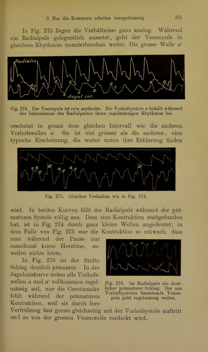 In Fig. 275 liegen die Verhältnisse ganz analog. Während ein Radialpuls gelegentlich aussetzt, geht der Venenpuls in gleichem Rhythmus ununterbrochen weiter. Die grosse Welle a' Fig. 274. Der Venenpuls ist rein aurikulär. Die Vorhofsystole a behält während der Intermission des Radialpulses ihren regelmässigen Rhythmus bei. erscheint in genau dem gleichen Intervall wie die anderen Vorhofswellen a. Sie ist viel grösser als die anderen, eine typische Erscheinung, die weiter unten ihre Erklärung finden Fig. 275. Gleiches Verhalten wie in Fig. 274. , r\ 7y 7y wird. In beiden Kurven fällt der Radialpuls während der prä- maturen Systole völlig aus. Dass eine Kontraktion stattgefunden hat, ist in Fig. 274 durch ganz kleine Wellen angedeutet; in dem Falle von Fig. 275 war die Kontraktion so schwach, dass man während der Pause nur manchmal kurze Herztöne, zu- weilen nichts hörte. In Fig. 276 ist der fünfte Schlag deutlich prämatur. In der Jugulariskurve treten alle Vorhofs- wellen a und a‘ vollkommen regel- mässig auf, nur die Carotiszacke fehlt während der prämaturen Kontraktion, weil sie durch ihre Verfrühung fast genau gleichzeitig mit der Vorhofsystole auftritt und so von der grossen Venen welle verdeckt wird. JVN/vNK s /V Fig. 276. Im Radialpuls ein deut- licher prämaturer Schlag. Der aus Vorhofsystolen bestehende Venen- puls geht regelmässig weiter.