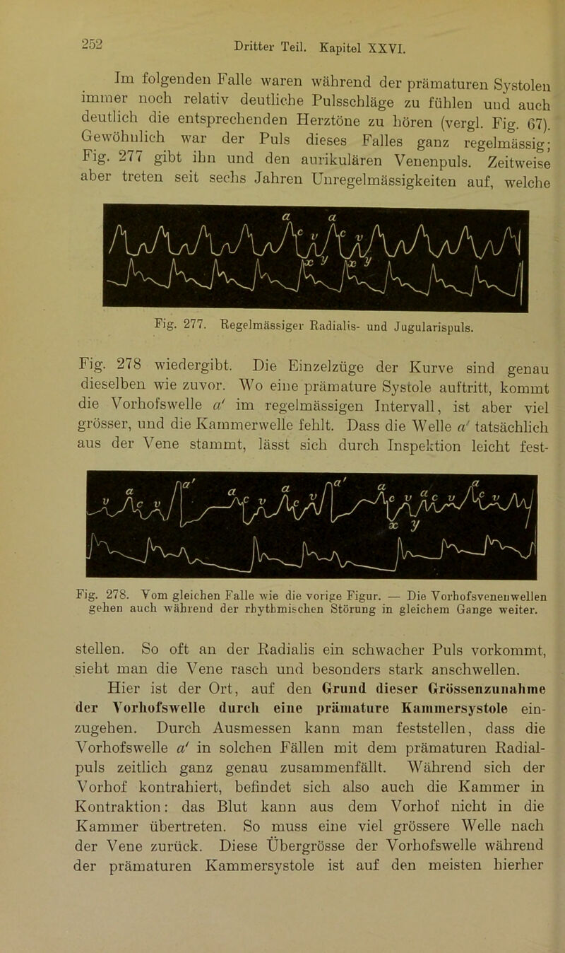 Im folgenden Falle waren während der prämaturen Systolen immer noch relativ deutliche Pulsschläge zu fühlen und auch deutlich die entsprechenden Herztöne zu hören (vergl. Fig. 67). Gewöhnlich w'ar der Puls dieses Falles ganz regelmässig; Fig. 2<7 gibt ihn und den aurikulären Venenpuls. Zeitweise aber treten seit sechs Jahren Unregelmässigkeiten auf, welche Fig. 277. Regelmässiger Radialis- und Jugularispuls. Fig. 278 wiede|gibt. Die Einzelzüge der Kurve sind genau dieselben wie zuvor. Wo eine prämature Systole auftritt, kommt die Vorhofswelle a‘ im regelmässigen Intervall, ist aber viel grösser, und die Kammerwelle fehlt. Dass die Welle a! tatsächlich aus der Vene stammt, lässt sich durch Inspektion leicht fest- Fig. 278. Vom gleichen Falle wie die vorige Figur. — Die Vorhofsveneuwellen gehen auch während der rhythmischen Störung in gleichem Gange weiter. stellen. So oft an der Radialis ein schwacher Puls vorkommt, sieht man die Vene rasch und besonders stark anschwellen. Hier ist der Ort, auf den Grund dieser Grüssenzunalune der Vorhofswelle durch eine prämature Kammersystole ein- zugehen. Durch Ausmessen kann man feststellen, dass die Vorhofswelle a‘ in solchen Fällen mit dem prämaturen Radial- puls zeitlich ganz genau zusammenfällt. Während sich der Vorhof kontrahiert, befindet sich also auch die Kammer in Kontraktion: das Blut kann aus dem Vorhof nicht in die Kammer übertreten. So muss eine viel grössere Welle nach der Vene zurück. Diese Übergrösse der Vorhofswelle während der prämaturen Kammersystole ist auf den meisten hierher