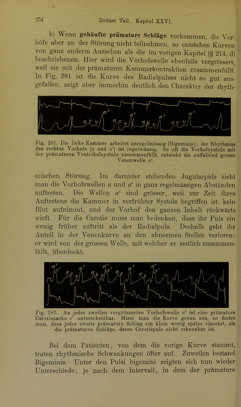 b) W enn gehäufte prämature Schläge Vorkommen, die Vor- höfe aber an der Störung nicht teilnehmen, so entstehen Kurven von ganz anderrn Aussehen als die im vorigen Kapitel (§ 214, d) beschriebenen. .Hier wird die Vorhofswelle ebenfalls vergrössert, weil sie mit der prämaturen Kammerkontraktion zusammenfällt. In Fig. 281 ist die Kurve des Radialpulses nicht so gut aus- gefallen, zeigt aber immerhin deutlich den Charakter der rhyth- Fig. 281. Die linke Kammer arbeitet unregelmässig (Bigeminie); der Rhythmus des rechten Vorhofs (a und a') ist regelmässig. So oft die Vorhofsystole mit der prämaturen Ventrikelsystole zusammenfällt, entsteht die auffallend grosse Venenwelle a‘. mischen Störung. Im darunter stehenden Jugularpuls sieht man die Vorhofswellen a und a! in ganz regelmässigen Abständen auftreten. Die Wellen a! sind grösser, weil zur Zeit ihres Auftretens die Kammer in verfrühter Systole begriffen ist, kein Blut aufnimmt, und der Vorhof den ganzen Inhalt rückwärts wirft. Für die Carotis muss man bedenken, dass ihr Puls ein wenig früher auftritt als der Radialpuls. Deshalb geht ihr Anteil in der Venenkurve an den abnormen Stellen verloren: er wird von der grossen Welle, mit welcher er zeitlich zusammen- fällt, überdeckt. Fig. 282. An jeder zweiten vergrösserten Vorhofswelle a‘ ist eine prämature Carotiszacke c' unterscheidbar. Misst man die Kurve genau aus, so findet man, dass jeder zweite prämature Schlag ein klein wenig später einsetzt, als ■die prämaturen Schläge, deren Carotispuls nicht erkennbar ist. Bei dem Patienten, von dem die vorige Kurve stammt, traten rhythmische Schwankungen öfter auf. Zuweilen bestand Bigeminie. Unter den Pulsi bigemini zeigten sich nun wieder Unterschiede, je nach dem Intervall, in dem der prämature