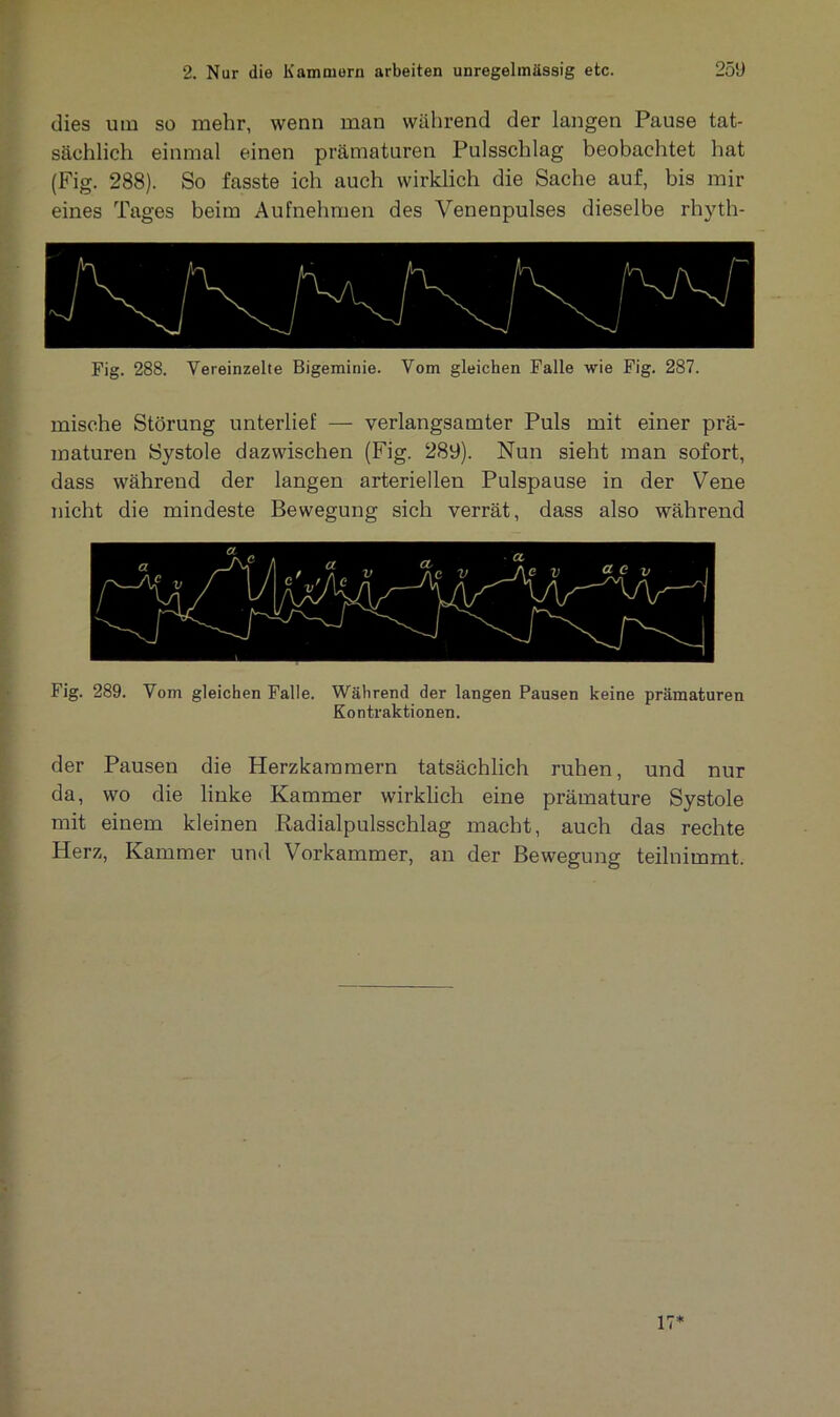dies um so mehr, wenn man während der langen Pause tat- sächlich einmal einen prämaturen Pulsschlag beobachtet hat (Fig. 288). So fasste ich auch wirklich die Sache auf, bis mir eines Tages beim Aufnehmen des Venenpulses dieselbe rhyth- Fig. 288. Vereinzelte Bigeminie. Vom gleichen Falle wie Fig. 287. mische Störung unterlief — verlangsamter Puls mit einer prä- maturen Systole dazwischen (Fig. 289). Nun sieht man sofort, dass während der langen arteriellen Pulspause in der Vene nicht die mindeste Bewegung sich verrät, dass also während Fig. 289. Vom gleichen Falle. Während der langen Pausen keine prämaturen Kontraktionen. der Pausen die Herzkammern tatsächlich ruhen, und nur da, wo die linke Kammer wirklich eine prämature Systole mit einem kleinen .Radialpulsschlag macht, auch das rechte Herz, Kammer und Vorkammer, an der Bewegung teilnimmt.