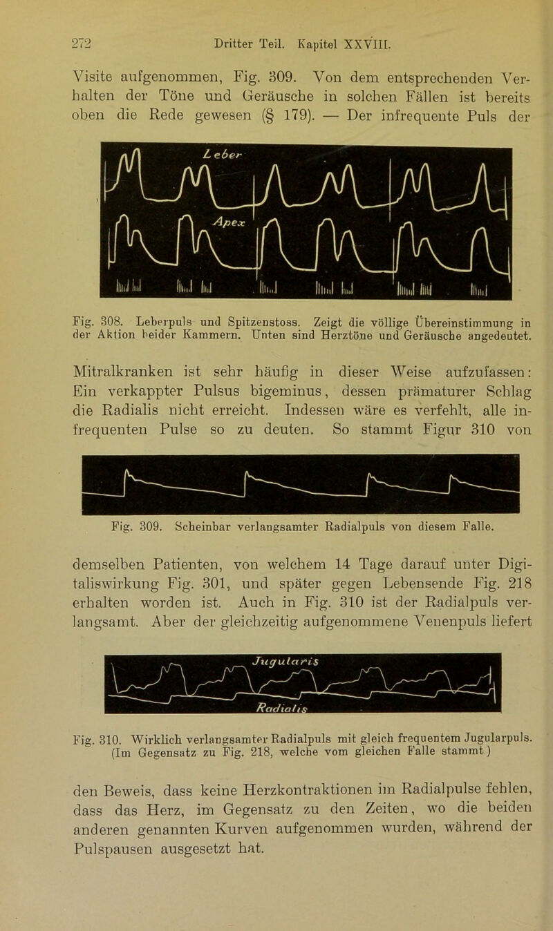 Visite aufgenommen, Fig. 309. Von dem entsprechenden Ver- halten der Töne und Geräusche in solchen Fällen ist bereits oben die Rede gewesen (§ 179). — Der infrequente Puls der Fig. 308. Leberpuls und Spitzenstoss. Zeigt die völlige Übereinstimmung in der Aktion beider Kammern. Unten sind Herztöne und Geräusche angedeutet. Mitralkranken ist sehr häufig in dieser Weise aufzufassen: Ein verkappter Pulsus bigeminus, dessen prämaturer Schlag die Radialis nicht erreicht. Indessen wäre es verfehlt, alle in- frequenten Pulse so zu deuten. So stammt Figur 310 von Fig. 809. Scheinbar verlangsamter Radialpuls von diesem Falle. demselben Patienten, von welchem 14 Tage darauf unter Digi- taliswirkung Fig. 301, und später gegen Lebensende Fig. 218 erhalten worden ist. Auch in Fig. 310 ist der Radialpuls ver- langsamt. Aber der gleichzeitig aufgenommene Venenpuls liefert Fig. 810. Wirklich verlangsamter Radialpuls mit gleich frequentem Jugularpuls. (Im Gegensatz zu Fig. 218, welche vom gleichen Falle stammt.) den Beweis, dass keine Herzkontraktionen im Radialpulse fehlen, dass das Herz, im Gegensatz zu den Zeiten, wo die beiden anderen genannten Kurven aufgenommen wurden, während der Pulspausen ausgesetzt hat.