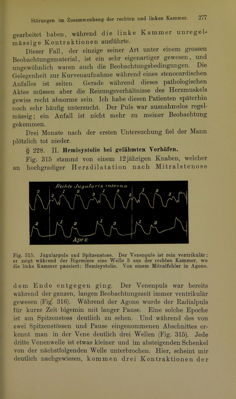 gearbeitet haben, während die linke Kammer uniegel- mässige Kontraktionen ausführte. Dieser Fall, der einzige seiner Art unter einem grossen Beobachtungsmaterial, ist ein sehr eigenartiger gewesen, und ungewöhnlich waren auch die Beobachtungsbedingungen. Die Gelegenheit zur Kurvenaufnahme während eines stenocardischen Anfalles ist selten. Gerade während dieses pathologischen Aktes müssen aber die Reizungsverhältnisse des Herzmuskels gewiss recht abnorme sein. Ich habe diesen Patienten späterhin noch sehr häufig untersucht. Der Puls war ausnahmslos regel- mässig; ein Anfall ist nicht mehr zu meiner Beobachtung gekommen. Drei Monate nach der ersten Untersuchung fiel der Mann plötzlich tot nieder. § 228. H. Hemisystolie bei gelähmten Yorhöfen. Fig. 315 stammt von einem 12jährigen Knaben, welcher an hochgradiger Herzdilatation nach Mitralstenose Fig. 315. Jugularpuls und Spitzenstoss. Der Venenpuls ist rein ventrikulär; er zeigt während der Bigemmie eine Welle 3 aus der rechten Kammer, wo die linke Kammer pausiert: Hemisystolie. Von einem Mitralfehler in Agone. dem Ende entgegen ging. Der Yenenpuls war bereits während der ganzen, langen Beobachtungszeit immer ventrikulär gewesen (Fig*. 316). Während der Agone wurde der Radialpuls für kurze Zeit bigemin mit langer Pause. Eine solche Epoche ist am Spitzenstoss deutlich zu sehen. Und während des von zwei Spitzenstössen und Pause eingenommenen Abschnittes er- kennt man in der Vene deutlich drei Wellen (Fig. 315). Jede dritte Venenwelle ist etwas kleiner und im absteigenden Schenkel von der nächstfolgenden Welle unterbrochen. Hier, scheint mir deutlich nachgewiesen, kommen drei Kontraktionen der