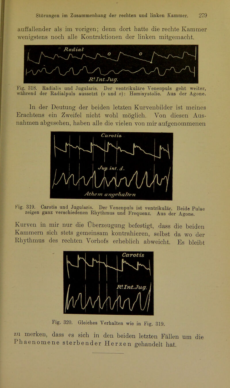 auffallender als im vorigen; denn dort batte die rechte Kammer wenigstens noch alle Kontraktionen der linken mitgemacht. Fig. 318. Radialis und Jugularis. Der ventrikuläre Yenenpuls geht weiter, während der Radialpuls aussetzt (o und o): Hemisystolie. Aus der Agone. ln der Deutung der beiden letzten Kurvenbilder ist meines Erachtens ein Zweifel nicht wohl möglich. Von diesen Aus- nahmen abgesehen, haben alle die vielen von mir aufgenommenen Fig. 319. Carotis und Jugularis. Der Yenenpuls ist ventrikulär. Beide Pulse zeigen ganz verschiedenen Rhythmus und Frequenz. Aus der Agone. Kurven in mir nur die Überzeugung befestigt, dass die beiden Kammern sich stets gemeinsam kontrahieren, selbst da wo der Rhythmus des rechten Vorhofs erheblich abweicht. Es bleibt Fig. 320. Gleiches Verhalten wie in Fig. 319. zu merken, dass es sich in den beiden letzten Fällen um die I haenomene sterbender Herzen gehandelt hat.