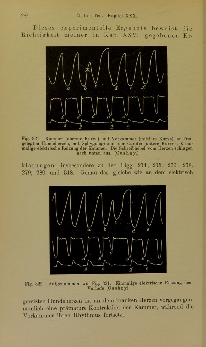 Dieses experimentelle Ergebnis beweist die Richtigkeit meiner in Kap. XXVI gegebenen Er- Fig. 321. Kammer (oberste Kurve) und Vorkammer (mittlere Kurve) au frei- gelegten Hundeherzen, mit Sphygmogramm der Carotis (untere Kurve); x ein- malige elektrische Reizung der Kammer. Die Schreibhebel vom Herzen schlagen nach unten aus. (Cushny.) klärungen, insbesondere zu den Figg. 274, 275, 276, 278, 279, 280 und 318. Genau das gleiche wie an dem elektrisch Fig. 322. Aufgenommen wie Fig. 321. Einmalige elektrische Reizung des Vorhofs (Cushny). gereizten Hundelierzen ist an dem kranken Herzen vorgegangen, nämlich eine prämature Kontraktion der Kammer, während die Vorkammer ihren Rhythmus fortsetzt.