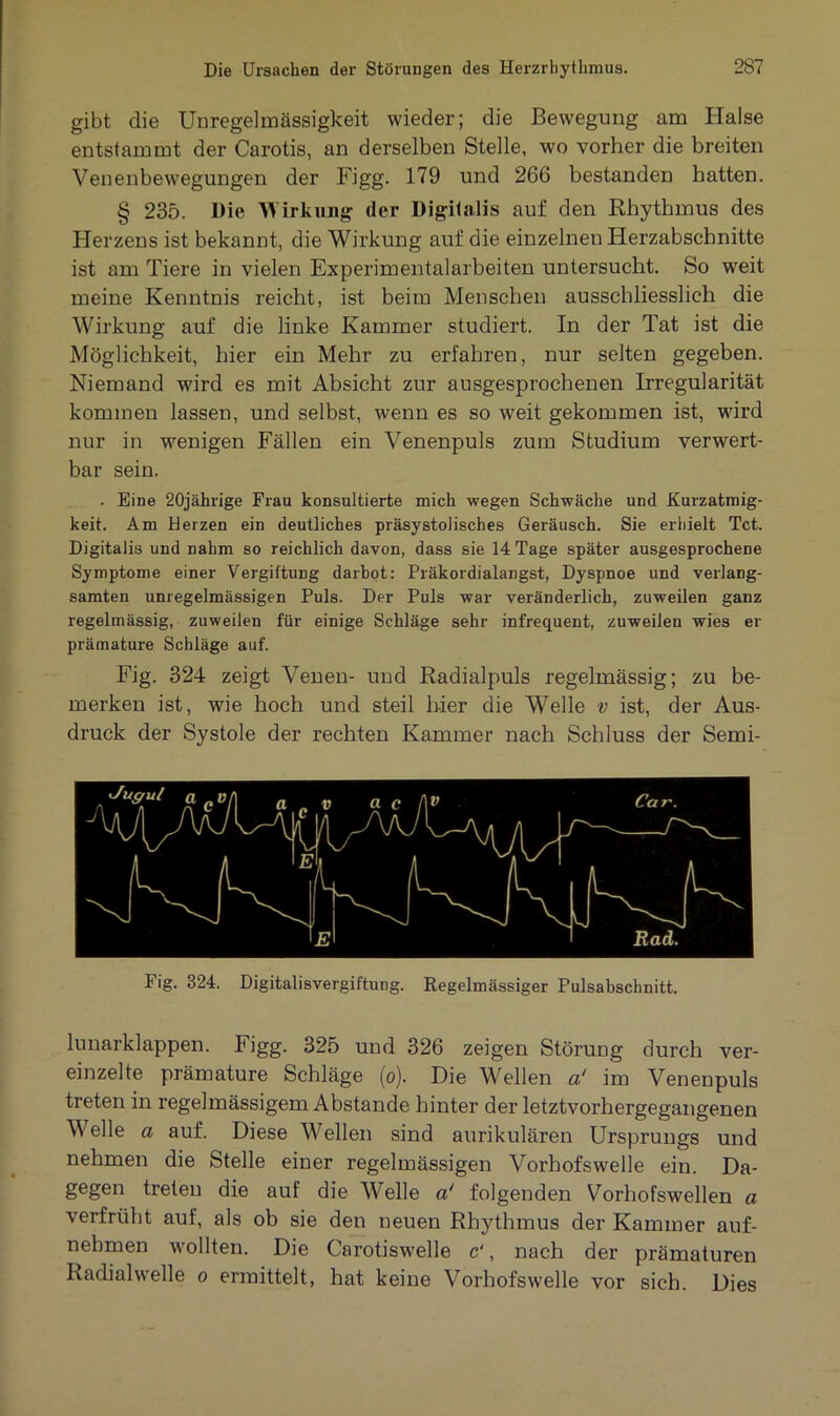 gibt die Unregelmässigkeit wieder; die Bewegung am Halse entstammt der Carotis, an derselben Stelle, wo vorher die breiten Venenbewegungen der Figg. 179 und 266 bestanden hatten. § 235. Die Wirkung der Digitalis auf den Rhythmus des Herzens ist bekannt, die Wirkung auf die einzelnen Herzabschnitte ist am Tiere in vielen Experimentalarbeiten untersucht. So weit meine Kenntnis reicht, ist beim Menschen ausschliesslich die Wirkung auf die linke Kammer studiert. In der Tat ist die Möglichkeit, hier ein Mehr zu erfahren, nur selten gegeben. Niemand wird es mit Absicht zur ausgesprochenen Irregularität kommen lassen, und selbst, wenn es so weit gekommen ist, ward nur in wenigen Fällen ein Venenpuls zum Studium verwert- bar sein. . Eine 20jährige Frau konsultierte mich wegen Schwäche und Kurzatmig- keit. Am Herzen ein deutliches präsystolisches Geräusch. Sie erhielt Tct. Digitalis und nahm so reichlich davon, dass sie 14 Tage später ausgesprochene Symptome einer Vergiftung darbot: Präkordialangst, Dyspnoe und verlang- samten unregelmässigen Puls. Der Puls war veränderlich, zuweilen ganz regelmässig, zuweilen für einige Schläge sehr infrequent, zuweilen wies er prämature Schläge auf. Fig. 324 zeigt Venen- und Radialpuls regelmässig; zu be- merken ist, wie hoch und steil hier die Welle v ist, der Aus- druck der Systole der rechten Kammer nach Schluss der Semi- Fig. 324. Digitalisvergiftung. Regelmässiger Pulsabschnitt. lunarklappen. Figg. 325 und 326 zeigen Störung durch ver- einzelte prämature Schläge (o). Die Wellen a‘ im Venenpuls treten in regelmässigem Abstande hinter der letztvorhergegangenen Welle a auf. Diese Wellen sind aurikulären Ursprungs und nehmen die Stelle einer regelmässigen Vorhofswelle ein. Da- gegen treten die auf die Welle a' folgenden Vorhofswellen a verfrüht auf, als ob sie den neuen Rhythmus der Kammer auf- nehmen wollten. Die Carotiswelle c', nach der prämaturen Radialwelle o ermittelt, hat keine Vorhofswelle vor sich. Dies
