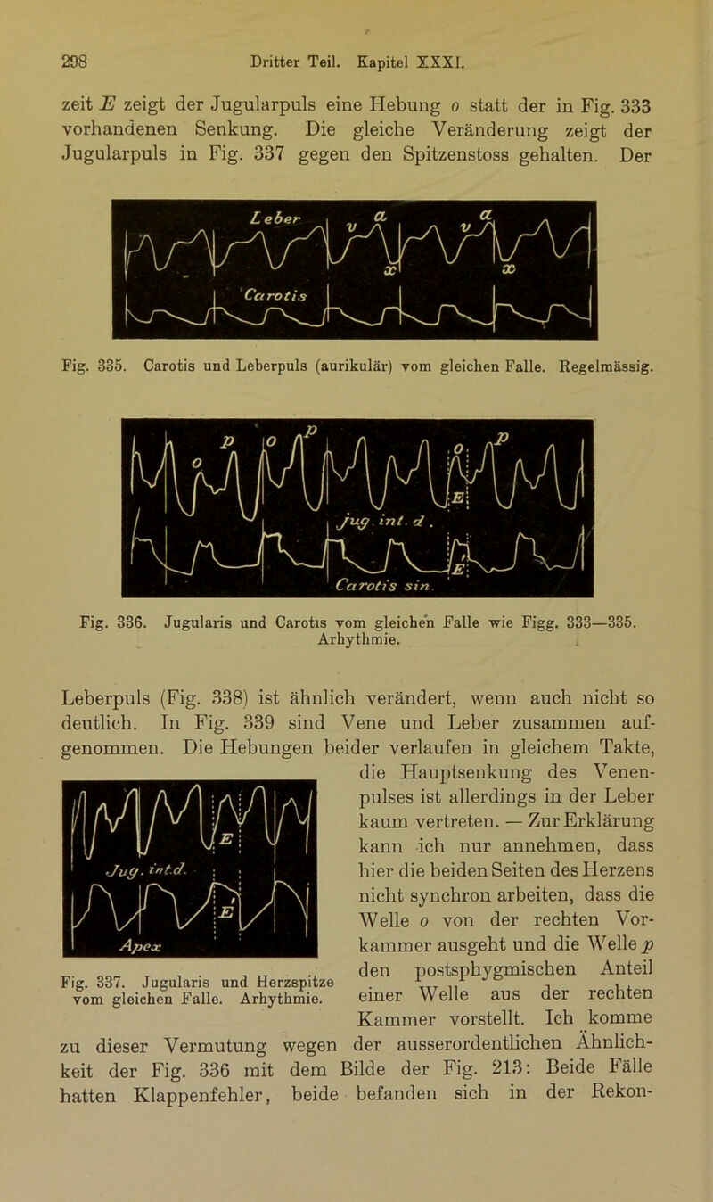 zeit E zeigt der Jugularpuls eine Hebung o statt der in Fig. 333 vorhandenen Senkung. Die gleiche Veränderung zeigt der Jugularpuls in Fig. 337 gegen den Spitzenstoss gehalten. Der Fig. 335. Carotis und Leberpuls (aurikulär) vom gleichen Falle. Regelmässig. Fig. 336. Jugularis und Carotis vom gleichen Falle wie Figg. 333—335. Arhythmie. Leberpuls (Fig. 338) ist ähnlich verändert, wenn auch nicht so deutlich. In Fig. 339 sind Vene und Leber zusammen auf- genommen. Die Hebungen beider verlaufen in gleichem Takte, die Hauptsenkung des Venen- pulses ist allerdings in der Leber kaum vertreten. — Zur Erklärung kann ich nur annehmen, dass hier die beiden Seiten des Herzens nicht synchron arbeiten, dass die Welle o von der rechten Vor- kammer ausgeht und die Welle p den postsphygmischen Anteil einer Welle aus der rechten Kammer vorstellt. Ich komme zu dieser Vermutung wegen der ausserordentlichen Ähnlich- keit der Fig. 336 mit dem Bilde der Fig. 213: Beide Fälle hatten Klappenfehler, beide befanden sich in der Rekon- Fig. 337. Jugularis und Herzspitze vom gleichen Falle. Arhythmie.