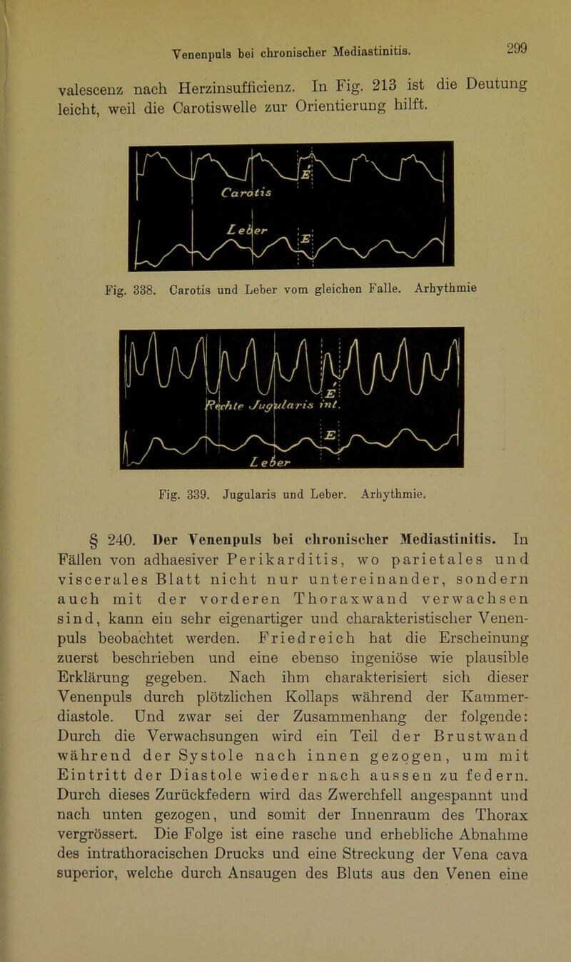valescenz nach Herzinsufficienz. In Fig. 213 ist die Deutung leicht, weil die Carotiswelle zur Orientierung hilft. Fig. 338. Carotis und Leber vom gleichen Falle. Arhythmie Fig. 339. Jugularis und Leber. Arhythmie. § 240. Der Venenpuls bei chronischer Mediastinitis. In Fällen von adhaesiver Perikarditis, wo parietales und viscerales Blatt nicht nur untereinander, sondern auch mit der vorderen Thorax wand verwachsen sind, kann eiu sehr eigenartiger und charakteristischer Venen- puls beobachtet werden. Friedreich hat die Erscheinung zuerst beschrieben und eine ebenso ingeniöse wie plausible Erklärung gegeben. Nach ihm charakterisiert sich dieser Venenpuls durch plötzlichen Kollaps während der Kammer- diastole. Und zwar sei der Zusammenhang der folgende: Durch die Verwachsungen wird ein Teil der Brustwand während der Systole nach innen gezogen, um mit Eintritt der Diastole wieder nach aussen zu federn. Durch dieses Zurückfedern wird das Zwerchfell angespannt und nach unten gezogen, und somit der Inuenraum des Thorax vergrössert. Die Folge ist eine rasche und erhebliche Abnahme des intrathoracischen Drucks und eine Streckung der Vena cava superior, welche durch Ansaugen des Bluts aus den Venen eine