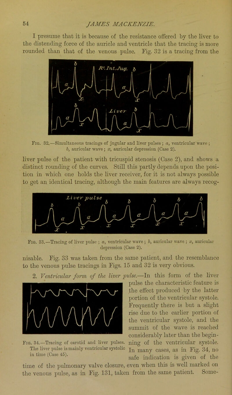 I presume that it is because of the resistance offered by the liver to the distending force of the auricle and ventricle that the tracing is moi'e rounded than that of the venous pulse. Fig. 32 is a tracing from the Fig. 32.—Simultaneous tracings of jugular and liver pulses ; a, ventricular wave ; 6, auricular wave ; x, auricular depression (Case 2). liver pulse of the patient with tricuspid stenosis (Case 2), and shows a distinct rounding of the curves. Still this partly depends upon the posi- tion in which one holds the liver receiver, for it is not always possible to get an identical tracing, although the main features are always recog- Fig. 33.—Tracing of liver pulse ; a, ventricular wave ; b, auricular wave ; x, auricular depression (Case 2). nisable. Fig. 33 was taken from the same patient, and the resemblance to the venous pulse tracings in Figs. 15 and 32 is very obvious. 2. Ventricular form of the liver pulse.—In this form of the liver pulse the characteristic feature is the effect produced by the latter portion of the ventricular systole. Frequently there is but a sHght rise due to the earlier portion of the ventricular systole, and the summit of the wave is reached considerably later than the begm- Fig. 34.—Tracing of carotid and liver pulses, ning of the ventricular systole. The liver pulse is mainly ventricular systolic ^g 34^ no in time (Case 45). indication is given of the time of the pulmonary valve closure, even when this is well marked on the venous pulse, as in Fig. 131, taken from the same patient. Some-