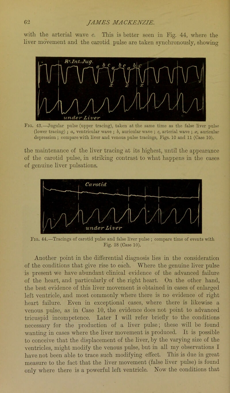 with the arterial wave c. This is better seen in Fig. 44, where the liver movement and the carotid pulse are taken synchronously, showing Fig. 43.—Jugular pulse (upper tracing), taken at the same time as the false liver pulse (lower tracing) ; a, ventricular wave ; h, auricular wave ; c, arterial wave ; *, amicular depression ; compare with liver and venous pulse tracings, Figs. 10 and 11 (Case 10). the maintenance of the liver tracing at its highest, until the appearance of the carotid pulse, in striking contrast to what happens m the cases of genuine liver pulsations. Fig. 44.—Tracings of carotid pulse and false liver pulse ; compare time of events wdth Fig. 28 (Case 10). Another point in the differential diagnosis lies in the consideration of the conditions that give rise to each. Where the genuine liver pulse is present we have abundant chnical evidence of the advanced failure of the heart, and particularly of the right heart. On the other hand, the best evidence of this liver movement is obtained in cases of enlarged left ventricle, and most commonly where there is no evidence of right heart failure. Even in exceptional cases, where there is likewise a venous pulse, as in Case 10, the evidence does not point to advanced tricuspid incompetence. Later I will refer briefly to the conditions necessary for the production of a liver pulse; these will be found wanting in cases where the Liver movement is produced. It is possible to conceive that the displacement of the liver, by the varying size of the ventricles, might modify the venous pulse, but in all my observations I have not been able to trace such modifying effect. This is due in great measure to the fact that the liver movement (false liver pulse) is found only where there is a powerful left ventricle. Now the conditions that