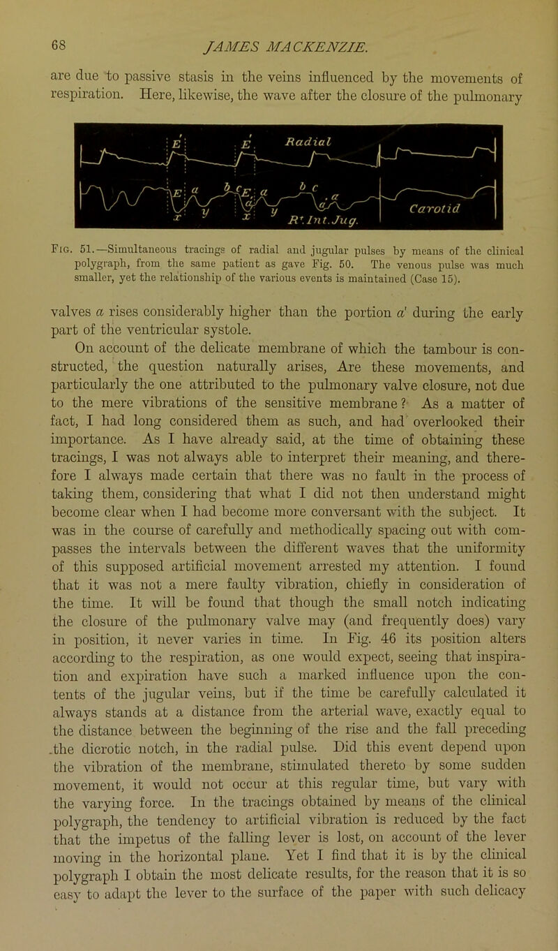 are due to passive stasis in the veins influenced by the movements of respiration. Here, hkewise, the wave after the closure of the pulmonary Fig. 51.—Simultaneou.s tracings of radial and jugular pulses by means of the clinical polygraph, from the same patient as gave Fig. 50. The venous pulse was much smaller, yet the relationship of the various events is maintained (Case 15). valves a rises considerably higher than the portion d during the early part of the ventricular systole. On account of the delicate membrane of which the tambour is con- structed, the question naturally arises. Are these movements, and particularly the one attributed to the pulmonary valve closure, not due to the mere vibrations of the sensitive membrane?- As a matter of fact, I had long considered them as such, and had overlooked their importance. As I have already said, at the time of obtaining these tracings, I was not always able to interpret their meaning, and there- fore I always made certain that there was no fault in the process of taking them, considering that what I did not then understand might become clear when I had become more conversant with the subject. It was in the course of carefully and methodically spacing out with com- passes the intervals between the different waves that the uniformity of this supposed artificial movement arrested my attention. I found that it was not a mere faulty vibration, chiefly in consideration of the time. It will be foimd that though the small notch indicating the closure of the pulmonary valve may (and frequently does) vary in position, it never varies in time. In Fig. 46 its position alters accordmg to the respiration, as one would expect, seeing that inspha- tion and expiration have such a marked influence upon the con- tents of the jugular veins, but if the time be carefully calculated it always stands at a distance from the arterial wave, exactly equal to the distance between the beginning of the rise and the fall preceding .the dicrotic notch, in the radial pulse. Did this event depend upon tlie vibration of the membrane, stimulated thereto by some sudden movement, it would not occur at this regular time, but vary with the varying force. In the tracings obtamed by means of the clinical polygraph, the tendency to artificial vibration is reduced by the fact that the impetus of the falling lever is lost, on account of the lever moving in the horizontal plane. Yet I find that it is by the cluiical polygraph I obtain the most delicate results, for the reason that it is so easy to adapt the lever to the surface of the paper with such delicacy