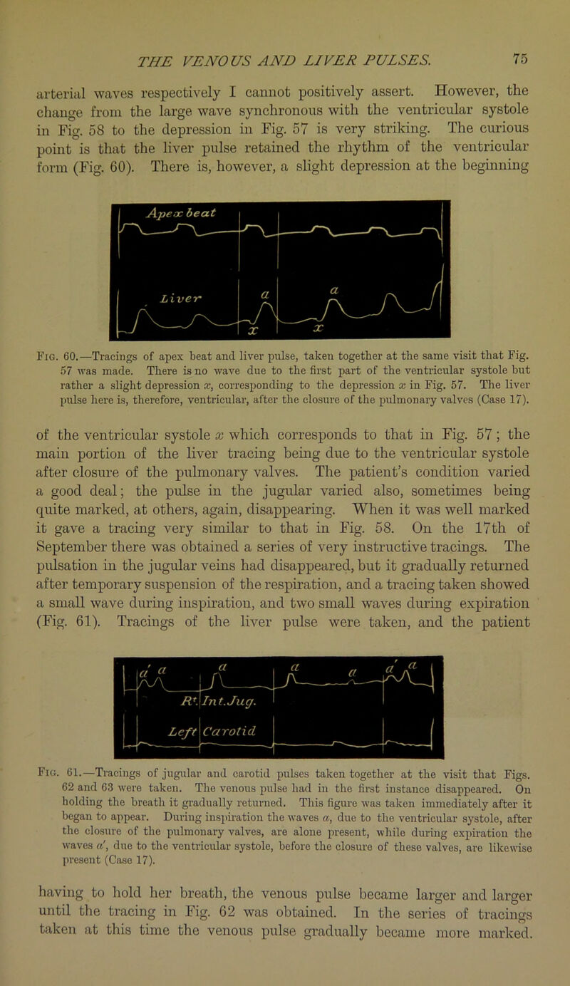 arterial waves respectively I cannot positively assert. However, the change from the large wave synchronous with the ventricular systole in Fig. 58 to the depression in Fig. 57 is very striking. The curious point is that the liver pulse retained the rhythm of the ventricular form (Fig. 60). There is, however, a slight depression at the beginning Fig. 60.—Tracings of apex beat and liver pulse, taken together at the same visit that Fig. 57 was made. There is no wave due to the first part of the ventricular systole but rather a slight depression a;, corresponding to the depression x in Fig. 57. The liver pulse here is, therefore, ventricular, after the closure of the pulmonary valves (Case 17). of the ventricular systole x which corresponds to that in Fig. 57; the main portion of the liver tracing being due to the ventricular systole after closure of the pulmonary valves. The patient’s condition varied a good deal; the pulse in the jugular varied also, sometimes being quite marked, at others, again, disappearing. When it was well marked it gave a tracing very similar to that in Fig. 58. On the 17th of September there was obtained a series of very instructive tracings. The pulsation in the jugular veins had disappeared, but it gradually returned after temporary suspension of the respiration, and a tracing taken showed a small wave during inspiration, and two small waves during expiration (Fig. 61). Tracings of the liver pulse were taken, and the patient Fig. 61.—Tracings of jugular and carotid pulses taken together at the visit that Figs. 62 and 63 were taken. The venous pulse had in the first instance disappeared. On holding the breath it gradually returned. This figure was taken immediately after it began to appear. During inspiration the waves a, due to the ventricular systole, after the closure of the pulmonary valves, are alone present, while during expiration the waves a', due to the ventricular systole, before the closure of these valves, are likewdse present (Case 17). having to hold her breath, the venous pulse became larger and larger until the tracing in Fig. 62 was obtained. In the series of tracings taken at this time the venous pulse gradually became more marked.