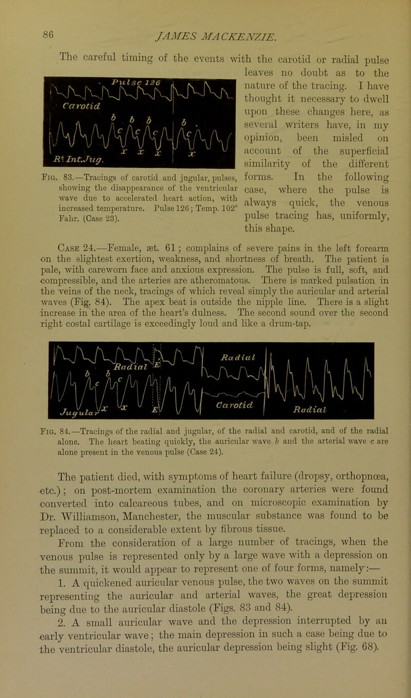The careful timing of the events with the carotid or radial pulse leaves no doubt as to the nature of the tracing. I have thought it necessary to dwell upon these changes here, as seveial writers have, in my opinion, been misled on account of the superficial similarity of the different . 83.—Tracings of carotid and jngular, pulses, forms. In the following showing the disappearance of the ventricular case, where the pulse is wave due to accelerated heart action, with ■ i, i„c,»3ed tsmper.tu.e. Puka 126; Tem^. 102 Fahr. (Case 23). P^^se tracing has, uniformly, this shape. Pulse 126 ■vrvjv.rvjvKivj Carotid liWvVViA ' ^ 1C X 'MAi/ X RMnt.Jug. Case 24.—Female, set. 61 \ complains of severe pains in the left forearm on the slightest exertion, weakness, and shortness of breath. The patient is pale, with careworn face and anxious expression. The pulse is full, soft, and compressible, and the arteries are atheromatous. There is marked pulsation in the veins of the neck, tracings of which reveal simply the auricular and arterial waves (Fig. 84). The apex beat is outside the nipple line. There is a slight increase in the area of the heart’s dulness. The second sound over the second right costal cartilage is exceedingly loud and like a drum-tap. Fig. 84.—Tracings of the radial and jugular, of the radial and carotid, and of the radial alone. The heart beating quickly, the auricular wave h and the arterial wave c are alone present in the venous pulse (Case 24). The patient died, with symptoms of heart failure (dropsy, orthopnoea, €tc.); on post-mortem examination the coronary arteries were found converted into calcareous tubes, and on microscopic examination by Dr. Williamson, Manchester, the muscular substance was found to be replaced to a considerable extent by fibrous tissue. From the consideration of a large number of tracings, when the venous pulse is represented only by a large wave with a depression on the summit, it would appear to represent one of four forms, namely:— 1. A quickened auricular venous pulse, the two waves on the summit representing the auricular and arterial waves, the great depression being due to the auricular diastole (Figs. 83 and 84). 2. A small auricular wave and the depression interrupted by an early ventricular wave) the main depression in such a case being due to the ventricular diastole, the auricular depression being slight (Fig. 68).