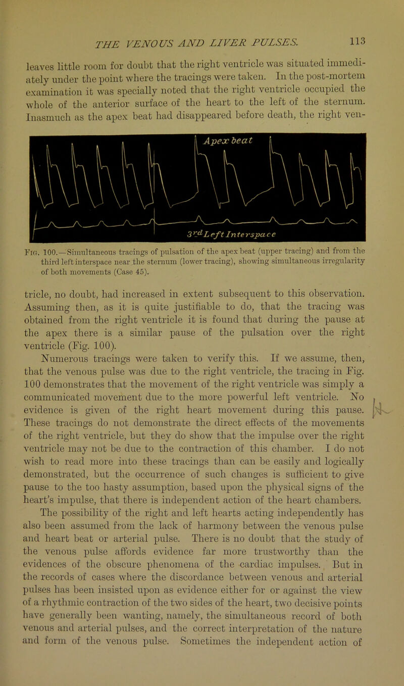 leaves little room for doubt that the right ventricle was situated immedi- ately under the point where the tracings were taken. In the post-mortem examination it was specially noted that the right ventricle occupied the whole of the anterior surface of the heart to the left of the sternum. Inasmuch as the apex beat had disappeared before death, the right ven- Fio. 100.—Simultaneous tracings of pulsation of the apex heat (upper tracing) and from the third left interspace near the sternum (lower tracing), showing simultaneous irregularity of both movements (Case 45). tricle, no doubt, had increased in extent subsequent to this observation. Assuming then, as it is quite justifiable to do, that the ti’acing was obtained from the right ventricle it is found that during the pause at the apex there is a similar pause of the pulsation over the right ventricle (Fig. 100). Numerous tracings were taken to verify this. If we assume, then, that the venous pulse was due to the right ventricle, the tracing in Fig. 100 demonstrates that the movement of the right ventricle was simply a communicated movement due to the more powerful left ventricle. No evidence is given of the right heart movement during this pause. These tracings do not demonstrate the direct effects of the movements of the right ventricle, but they do show that the impulse over the right ventricle may not be due to the contraction of this chamber. I do not wish to read more into these tracings than can be easily and logically demonstrated, but the occurrence of such changes is sufficient to give pause to the too hasty assumption, based upon the physical signs of the heart’s impulse, that there is independent action of the heart chambers. The possibility of the right and left hearts acting independently has also been assumed from the lack of harmony between the venous pulse and heart beat or arterial pulse. There is no doubt that the study of the venous pulse affords evidence far more trustworthy than the evidences of the obscure phenomena of the cardiac impulses., But in the records of cases where the discordance between venous and arterial pulses has been insisted upon as evidence either for or against the view of a rhythmic contraction of the two sides of the heart, two decisive points have generally been wanting, namely, the simultaneous record of both venous and arterial pulses, and the correct interpretation of the nature and form of the venous pulse. Sometimes the independent action of