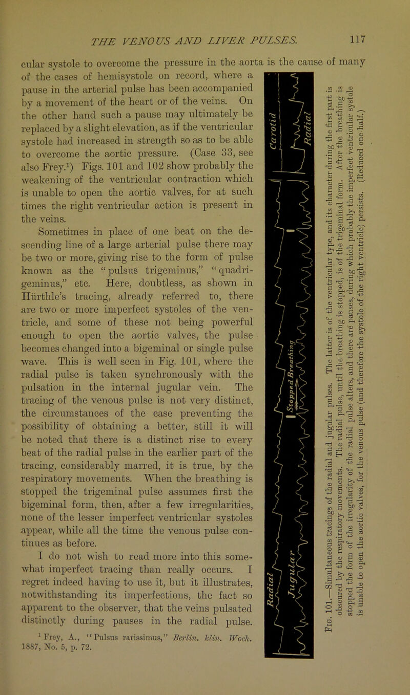 cular systole to overcome the pressure in the aorta is the cause of many of the cases of liemisystole on record, where a pause in the arterial pulse has been accompanied by a movement of the heart or of the veins. On the other hand such a pause may ultimately be replaced by a slight elevation, as if the ventricular systole had increased in strength so as to be able to overcome the aortic pressure. (Case o3, see also Frey.^) Figs. 101 and 102 show probably the weakening of the ventricular contraction which is unable to open the aortic valves, for at such times the right ventricular action is present in the veins. Sometimes in place of one beat on the de- scending line of a large arterial pulse there may be two or more, giving rise to the form of pulse known as the “pulsus trigeminus,” “quadri- geminus,” etc. Here, doubtless, as shown in Hurthle’s tracing, already referred to, there are two or more imperfect systoles of the ven- tricle, and some of these not being powerful enough to open the aortic valves, the pulse becomes changed into a bigeminal or single pulse wave. This is well seen in Fig. 101, where the radial pulse is taken synchronously with the pulsation in the internal jugular vein. The tracing of the venous pulse is not very distinct, the circumstances of the case preventing the possibility of obtaining a better, still it will be noted that there is a distinct rise to every beat of the radial pulse in the earlier part of the tracing, considerably marred, it is true, by the respiratory movements. When the breathing is stopped the trigeminal pulse assumes first the bigeminal form, then, after a few irregularities, none of the lesser imperfect ventricular systoles appear, while all the time the venous pulse con- tinues as before. I do not wish to read more into this some- what imperfect tracing than really occurs. I regret indeed having to use it, but it illustrates, notwithstanding its imperfections, the fact so apparent to the observer, that the veins pulsated distinctly during pauses in the radial pulse. ^ Frey, A., “Pulsus rarissimus,” Berlin. Min. Woch. 1887, No. f), p. 72. Pig. 101.—Simultaneous traeings of the radial and jugular pulses. The latter is of the ventricular type, and its character during the first part is obscured by the respiratory movements. The radial pulse, until the breathing is stopped, is of the trigeminal form. After the breathing is stopped the form of the irregularity of the radial pulse alters, and there are pauses, during which probably the imperfect ventricular systole is unable to open the aortic valves, for the venous pulse (and therefore the systole of the right ventricle) persists. (Reduced one-half.)