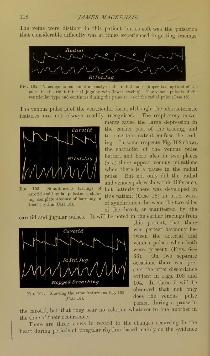 The veins were distinct in this patient, but so soft was the pulsation that considerable difficulty was at times experienced in getting tracuigs. Fig. 102.—Tracings taken simultaneously of the radial pulse (upper tracing) and of the pulse in the right internal jugular vein (lower traeing). The venous pulse is of the venti’icular type and continues during the pause (o, o') of the radial pulse (Case 18). The venous pulse is of the ventricular form, although the characteristic features are not always readily recognised. The respiratory move- ments cause the large depression in the earlier part of the tracing, and to a certain extent confuse the read- ing. In some respects Fig. 102 shows the character of the venous pulse better, and here also in two places (o, 6) there appear venous pulsations when there is a pause in the radial pulse. But not only did the radial and venous pulses show this difference. Fig. 103.—Simultaneous tracings of latterly there was developed in carotid and jugtdar pulsations, show- (Case 18) an utter want theii- rhythm (Case 18). of synchronism between the two sides of the heart, as manifested by the- carotid and jugular pulses. It will be noted in the earlier tracings from this patient, that there- was perfect harmony be- tween the arterial and venous pulses when both were present (Figs. 64- 66). On two separate occasions there was pre- sent the utter discordance evident in Figs. 103 and 104. In these it will be observed that not only does the venous pulse persist during a pause in the carotid, but that they bear no relation whatever to one another in Fig. 104.—Showing the same features as Fig. 103 (Case 18). the time of their occurrence. There are three views in regard to the changes occurring in the heart duruig periods of irregular rhythm, based mainly on the evidence