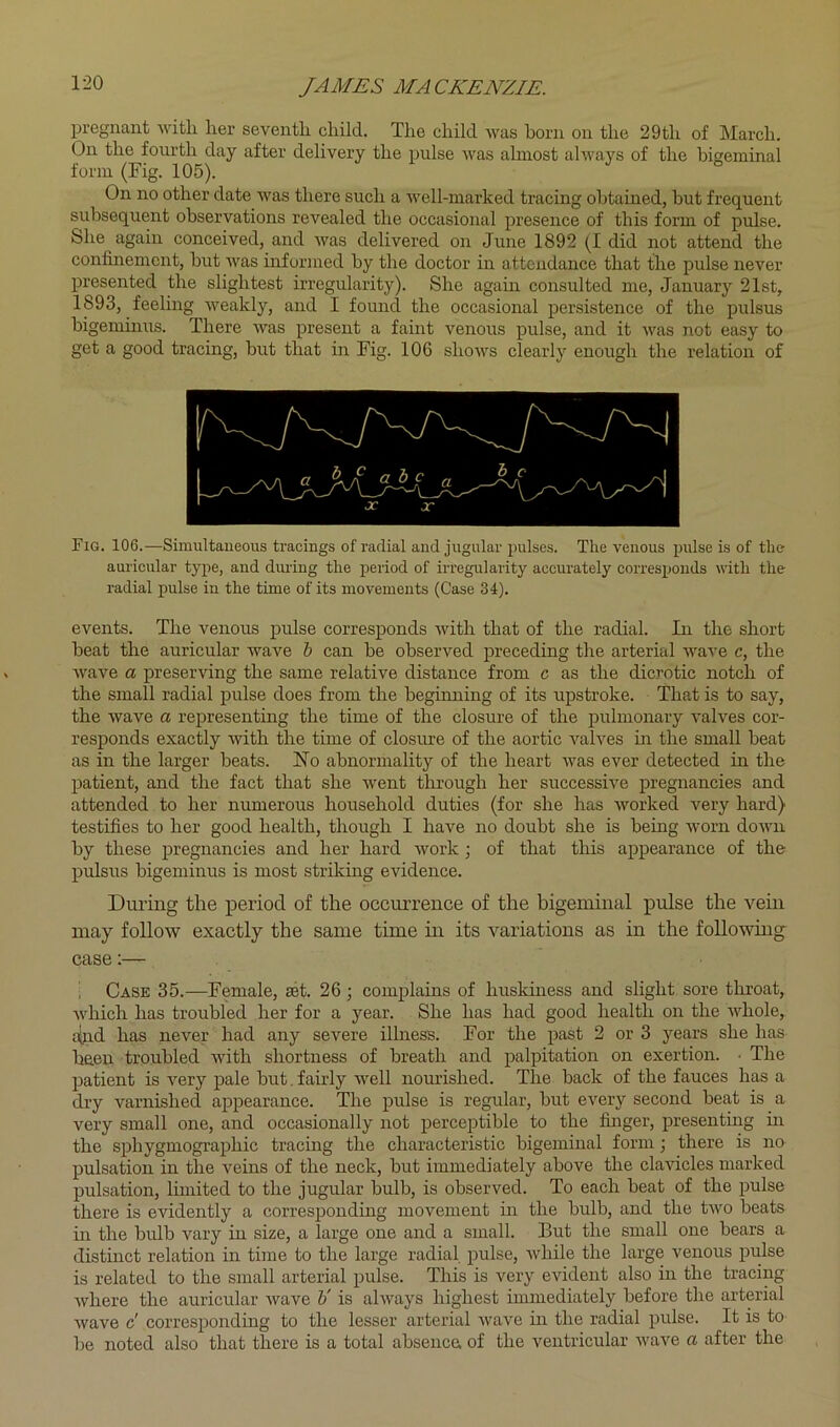 pregnant witli lier seventli child. The child was horn on the 29th of March. On the fourth day after delivery the pulse was almost always of the bigeminal form (Fig. 105). On no other date was there such a well-marked tracing obtained, but frequent subsequent observations revealed the occasional presence of this form of pulse. She again conceived, and was delivered on June 1892 did not attend the confinement, but was informed by the doctor in attendance that the pulse never presented the slightest irregularity). She again consulted me, January 21st, 1893, feelmg weakly, and I found the occasional persistence of the pulsus bigeminirs. There was present a faint venous pulse, and it was not easy to get a good tracing, but that in Fig. 106 shows clearly enough the relation of Fig. 106.—Simultaneous tracings of radial and jugular pulses. The venous pulse is of the auricular type, and diuing the period of irregularity accurately corresponds with the radial pulse in the time of its movements (Case 34). events. The venous pulse corresponds with that of the radial. In the short beat the auricular wave h can be observed preceding the arterial Avave c, the Avave a preserving the same relative distance from c as the dicrotic notch of the small radial pulse does from the beginning of its upstroke. That is to say, the Avave a representing the time of the closure of the pulmonary A’alves cor- responds exactly Avith the time of closure of the aortic A^alves in the small beat as in the larger beats. No abnormality of the heart Avas ever detected in the patient, and the fact that she Avent through her successhm pregnancies and attended to her numerous household duties (for she has Avorked A'^ery hard) testifies to her good health, though I have no doubt she is being Avorn doAvn by these pregnancies and her hard Avork; of that this appearance of the pulsus bigeminus is most striking evidence. During the period of the occurrence of the bigeminal pixlse the vein may follow exactly the same time in its variations as in the following case Case 35.—Female, set. 26; complains of huskmess and slight sore throat, Avhich has troubled her for a year. She has had good health on the AA’’hole, tyid has never had any severe illness. For the jiast 2 or 3 years she has baen troubled Avith shortness of breath and palpitation on exertion. • The patient is A'^ery pale but. fairly Avell nourished. The back of the fauces has a dry varnished appearance. The pulse is regular, but every second beat is a very small one, and occasionally not perceptible to the finger, presenting in the sphygmographic tracing the characteristic bigeminal form; there is no pulsation in the veins of the neck, but immediately above the clavicles marked pulsation, limited to the jugular bulb, is observed. To each beat of the pulse there is evidently a corresponding movement in the bulb, and the tAvo beats in the bulb vary in size, a large one and a small. I3ut the small one bears a distinct relation in time to the large radial pulse, Avhile the large venous pulse is related to the small arterial pulse. This is very evident also in the tracing Avhere the auricular Avave H is ahvays highest immediately before the arterial Avave c' corresponding to the lesser arterial Avave m the radial pulse. It is to be noted also that there is a total absence of the A'^entricular Avave a after the