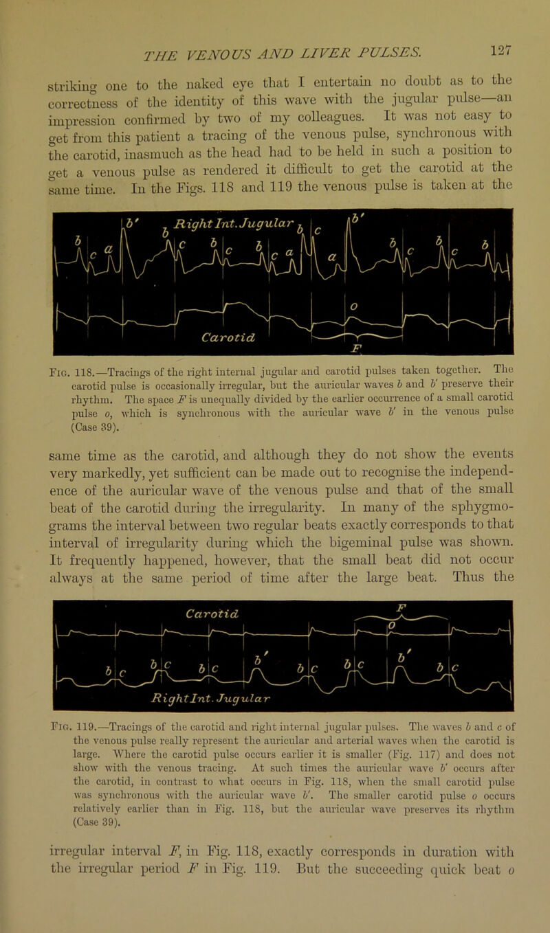 striking one to the naked eye that I entertaui no doubt as to the correctness of the identity of this wave with the jugular pulse—an impression confirmed by two of my colleagues. It was not easy to get from this patient a tracing of the venous pulse, synchronous with the carotid, inasmuch as the head had to be held in such a position to get a venous pulse as rendered it difficult to get the carotid at the same time. In the Figs. 118 and 119 the venous pulse is taken at the Fig. 118.—Tracings of the right internal jugular and carotid pulses taken together. The carotid pulse is occasionally irregular, hut the auricular waves 6 and h preserve their rhythm. The space F is unequally divided by the earlier occui-renee of a small carotid pulse 0, which is synchronous with the auricular wave V in the venous pulse (Case 39). same time as the carotid, and although they do not show the events very markedly, yet sufficient can be made out to recognise the independ- ence of the auricular wave of the venous pidse and that of the small beat of the carotid during the irregularity. In many of the sphygmo- grams the interval between two regular beats exactly corresponds to that interval of irregularity during which the bigeminal pulse was shown. It frequently happened, however, that the small beat did not occur always at the same period of time after the large beat. Thus the Fig. 119.—Tracings of the carotid and right internal jugular pulses. The waves h and c of the venous pulse really represent the auricular and arterial waves when the carotid is large. Where the carotid imlse occurs earlier it is smaller (Fig. 117) and does not show with the venous tracing. At such times the auricular wave h' occurs after the carotid, in contrast to what occurs in Fig. 118, when the small carotid pulse was synchronous with the auricular wave V. The smaller carotid pulse o occurs relatively earlier than in Fig. 118, but the auricular wave preserves its rhythm (Case 39). irregular interval F, in Fig. 118, exactly corresponds in duration with the irregular period F in Fig. 119. But the succeeding quick beat o