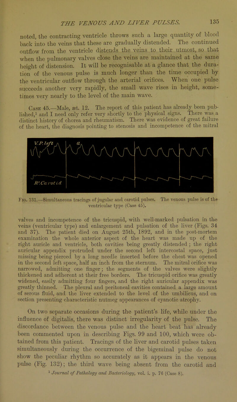 noted, the contracting ventricle throws such a large quantity of blood back into the veins that these are gradually distended. The continued outflow from the ventricle distends the veins to their utmost, so that when the pulmonary valves close the veins are maintained at the same height of distension. It will be recognisable at a glance that the dura- tion of the venous pulse is much longer than the time occupied by the ventricular outflow through the arterial orifices. When one pulse succeeds another very rapidly, the small wave rises in height, some- times very nearly to the level of the main wave. Case 45.—Male, set. 12. The report of this patient has already been pub- lished,^ and I need only refer very shortly to the physical signs. There was a distinct history of chorea and rheumatism. There was evidence of great failure of the heart, the diagnosis pointing to stenosis and incompetence of the mitral Fig. 131.—Simultaneous tracings of jugular and carotid pulses. ventricular type (Case 45). The venous pulse is of the • valves and incompetence of the tricuspid, with well-marked pulsation in the veins (ventricular type) and enlargement and pulsation of the liver (Figs. 34 and 37). The patient died on August 25th, 1892, and in the postmortem examination the whole anterior aspect of the heart was made up of the right auricle and ventricle, both cavities being greatly distended; the right auricular appendix protruded rmder the second left intercostal space, just missing being pierced by a long needle inserted before the chest was opened in the second left space, half an inch from the sternum. The mitral orifice was narrowed, admitting one finger; the segments of the valves were slightly thickened and adherent at their free borders. The tricuspid orifice was greatly widened, easily admitting four fingers, and the right auricular appendix was greatly thinned. The pleural and peritoneal cavities contained a large amount of serous fluid, and the liver extended to the level of the umbilicus, and on section presenting characteristic nutmeg appearances of cyanotic atrophy. On two separate occasions during the patient’s life, while under the influence of digitalis, there was distinct irregularity of the pulse. The discordance between the venous pulse and the heart beat has already been commented upon in describing Figs. 99 and 100, which were ob- tained from this patient. Tracings of the liver and carotid pulses taken simultaneously during the occurrence of the bigeminal pulse do not show the peculiar rhythm so accurately as it appears in the venous pulse (Fig. 132); the third wave being absent from the carotid and ^ Journal of Paihology and Bacteriology, vol. i. p. 76 (Case 8).