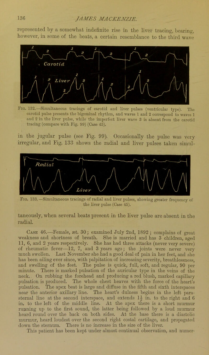 represented by a somewhat indefinite rise in the liver tracing, bearing, however, in some of the beats, a certam resemblance to the third wave Fig. 132.—Simultaneous tracings of carotid and liver pulses (ventricular type). Tlie carotid pulse presents the bigeminal rhythm, and waves 1 and 2 coiTespond to waves 1 and 2 in the liver pulse, while the imperfect liver wave 3 is absent from the carotid tracing (compare with Fig. 99) (Case 45). in the jugular pulse (see Fig. 99). Occasionally the pulse was very irregular, and Fig. 133 shows the radial and liver pulses taken simul- Fig. 133. —Simultaneous tracings of radial and Uver pulses, showing gi’eater frequency of the liver pulse (Case 45). taneously, when several beats present in the hver pulse are absent in the radial. Case 46.—Female, set. 30; exaroined July 2nd, 1892 ; complains of great weakness and shortness of breath. She is married and has 3 children, aged 11, 6, and 2 years respectively. She has had three attacks (never very severe) of rheumatic fever—12, 7, and 3 years ago; the joints were never very much swollen. Last November she had a good deal of pain in her feet, and she has been ailing ever since, with palpitation of increasing severity, breathlessness, and swelling of the feet. The pulse is quick, full, soft, and regular, 90 per minute. There is marked pulsation of the auricular type in the veins of the neck. On rubbing the forehead and producing a red blush, marked capillary pulsation is produced. The whole chest heaves with the force of the heart’s pulsation. The apex beat is large and diffuse in the fifth and sixth mterspaces near the anterior axillary line. The heart’s dulness begins in the left para- sternal line at the second interspace, and extends 1|- in. to the right and 6 in. to the left of the middle line. At the apex there is a short murmur running up to the first sound, the latter being followed by a loud murmur heard round over the back on both sides. At the base there is a diastolic murmur, heard loudest over the second right costal cartilage, and propagated down the sternum. There is no increase in the size of the liver. This patient has been kept mider almost continual observation, and numer-