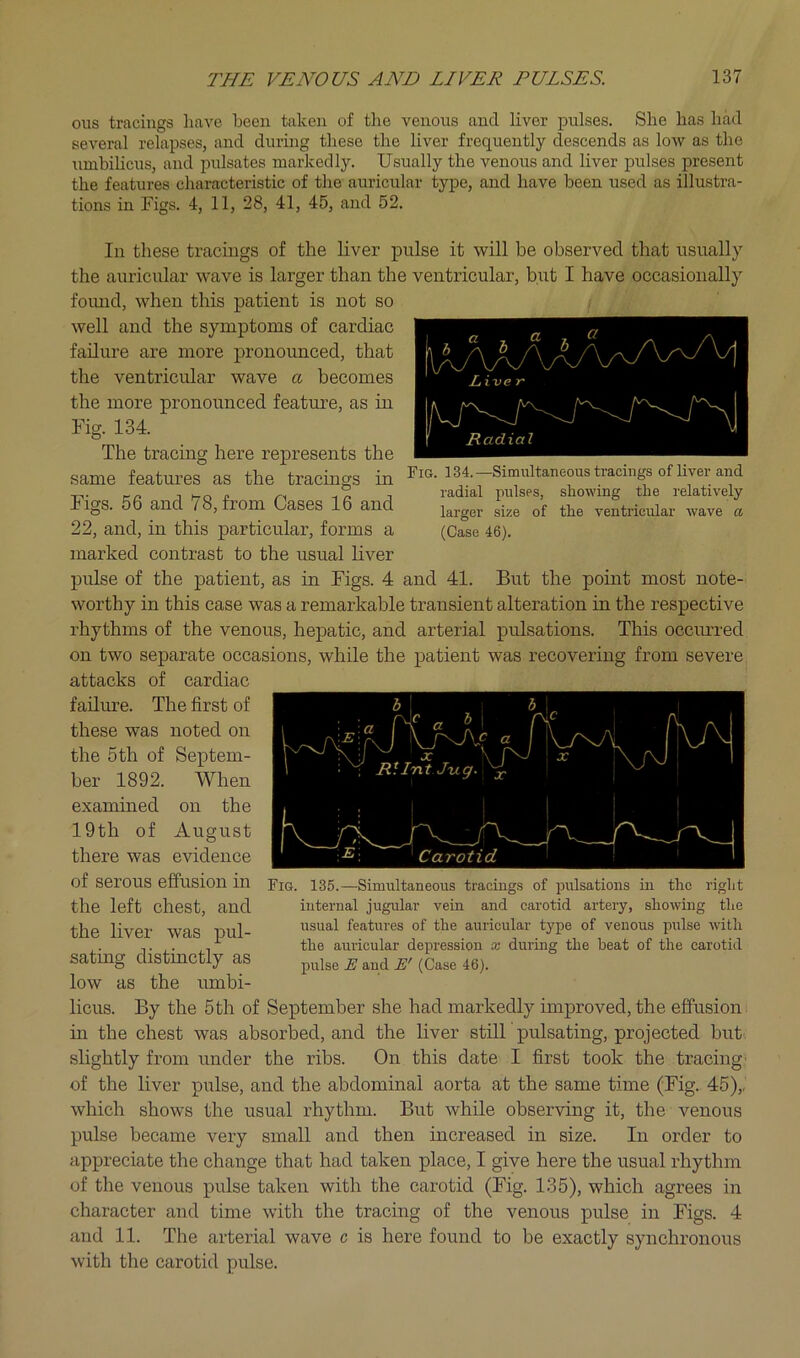 ous tracings Imve been taken of the venous and liver pulses. She has had several relapses, and during these the liver frequently descends as low as the umbihcus, and pulsates markedly. Usually the venous and liver pulses present the features characteristic of the auricular type, and have been used as illustra- tions in Figs. 4, 11, 28, 41, 45, and 52. a , fl- , a , T Lii-ve r Radial Fig. 134.—Simultaneous tracings of liver and radial pulses, showing the relatively larger size of the ventricular wave a, (Case 46). In these tracings of the liver pulse it will be observed that usually the auricular wave is larger than the ventricular, but I have occasionally foiuicl, when this patient is not so well and the symptoms of cardiac failure are more pronounced, that the ventricular wave a becomes the more pronounced feature, as in Fig. 134. The tracing here represents the same features as the tracings in Figs. 56 and 78, from Cases 16 and 22, and, in this particular, forms a marked contrast to the usual liver pulse of the patient, as in Figs. 4 and 41. But the point most note- worthy in this case was a remarkable transient alteration in the respective rhythms of the venous, hepatic, and arterial pulsations. This occiuTed on two separate occasions, while the patient was recovering from severe attacks of cardiac failure. The first of these was noted on the 5th of Septem- ber 1892. When examined on the 19th of August there was evidence of serous effusion in the left chest, and the liver was pul- sating distinctly as low as the umbi- licus. By the 5th of September she had markedly improved, the effusion in the chest was absorbed, and the liver still pulsating, projected but. slightly from under the ribs. On this date I first took the tracing' of the liver pulse, and the abdominal aorta at the same time (Fig. 45),, which shows the usual rhythm. But while observing it, the venous pulse became very small and then increased in size. In order to appreciate the change that had taken place, I give here the usual rhythm of the venous pulse taken with the carotid (Fig. 135), which agrees in character and time with the tracing of the venous pulse in Figs. 4 and 11. The arterial wave c is here found to be exactly synchronous with the carotid pulse. Fig. 135.—Simultaneous tracings of pulsations in tlic riglit internal jugular vein and carotid artery, showing the usual features of the auricular type of venous pulse with the auricular depression x during the heat of the earotid pulse E and E' (Case 46).