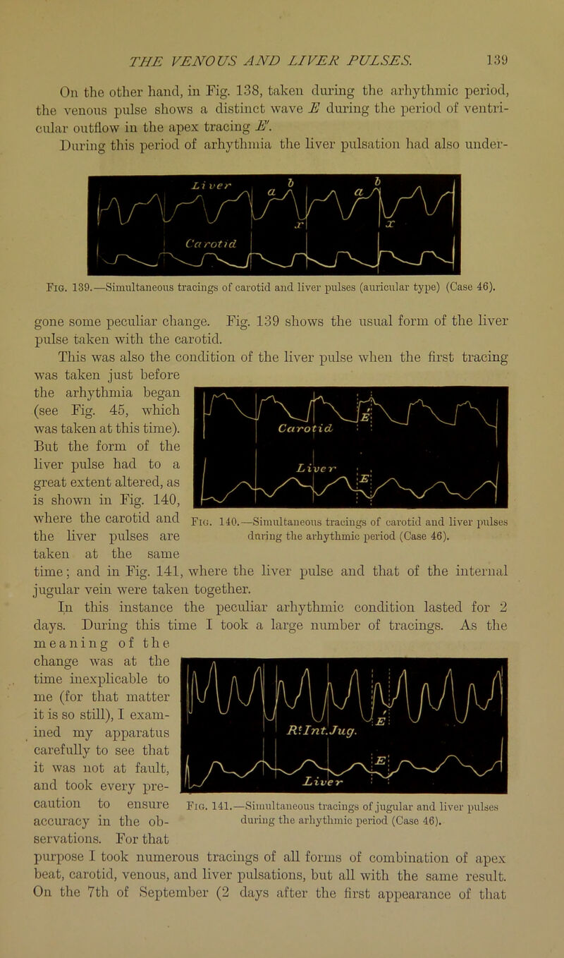 Oil the other hand, in Fig. 138, taken during the arhythmic period, the venous pulse shows a distinct wave E during the period of ventri- cidar outflow in the apex tracing E. During this period of arhythinia the liver pulsation had also under- Fig. 139.—Simultaneous tracings of carotid and liver pulses (auricular type) (Case 46). gone some peculiar change. Fig. 139 shows the usual form of the liver pulse taken with the carotid. This was also the condition of the liver pulse when the first tracing was taken just before the arhythmia began (see Fig. 45, which was taken at this time). But the form of the liver pulse had to a great extent altered, as is shown in Fig. 140, where the carotid and —Simultaneous tracings of carotid aud liver pulses the liver pulses are during the arhythmic period (Case 46). taken at the same time; and in Fig. 141, where the liver pulse and that of the internal jugular vein were taken together. In this instance the peculiar arhythmic condition lasted for 2 days. During this time I took a large number of tracings. As the meaning of the change was at the time inexplicable to me (for that matter it is so still), I exam- ined my apparatus carefully to see that it was not at fault, and took every pre- caution to ensure accuracy in the ob- servations. For that purpose I took numerous tracings of all forms of combination of apex beat, carotid, venous, and liver pulsations, but all with the same result. On the 7th of September (2 days after the first appearance of that Fig. 141.—Simultaneous tracings of jugular and liver pulse.s during the arhythmic period (Case 46).