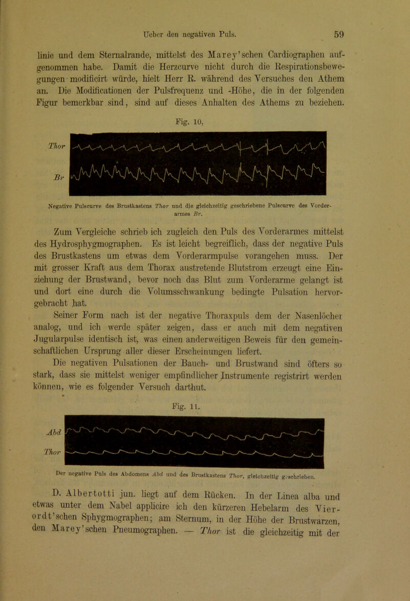 linie mid dem Sternalrande, mittelst des Marey’sehen Cardiographen auf- genommen habe. Damit die Herzeurve nicht durch die Respirationsbewe- gungen modificirt würde, hielt Herr R. während des Versuches den Athem an. Die Modificatiouen der Pulsfrequenz und -Höhe, die in der folgenden Figur bemerkbar sind, sind auf dieses Anhalten des Athems zu beziehen. Fig. 10, Thor Br Negative Pulscurve des Brustkastens Thor und dje gleichzeitig geschriebene Pulsourre des Vorder- armes Br, Zum Vergleiche schrieb ich zugleich den Puls des Vorderamies mittelst des Hydrosphygmographen. Es ist leicht begreiflich, dass der negative Puls des Brustkastens um etwas dem Vorderarmpulse vorangehen muss. Der mit grosser Kraft aus dem Thorax austretende Blutstrom erzeugt eine Ein- ziehung der Brustwand, bevor noch das Blut zum Vorderarme gelangt ist und dort eine durch die Volumsschwankung bedingte Pulsation hervor- gebracht hat. Seiner Form nach ist der negative Thoraxpuls dem der Nasenlöcher analog, und ich werde später zeigen, dass er auch mit dem negativen Jugulai-pulse identisch ist, was einen anderweitigen Beweis für den gemein- schaftlichen Ursprung aller dieser Erscheinungen liefert. Die negativen Pidsationen der Bauch- und Brustwand sind öfters so stark, dass sie mittelst weniger empfindlicher Instrumente registrirt werden können, wie es folgender Versuch darthut. Fig. 11. AU Thor Der negative Puls des Abdomens Äbd und des Brustkastens Thor, gleichzeitig geschrieben. D. Albertotti jun. liegt auf dem Rücken. In der Linea alba und etwas unter dem Nabel appheire ich den kürzeren Hebelarm des Vier- ordt’schen Sphygmographen; am Sternum, in der Höhe der Brustwarzen, den Marey’sehen Pneumographen. — Thor ist die gleichzeitig mit der