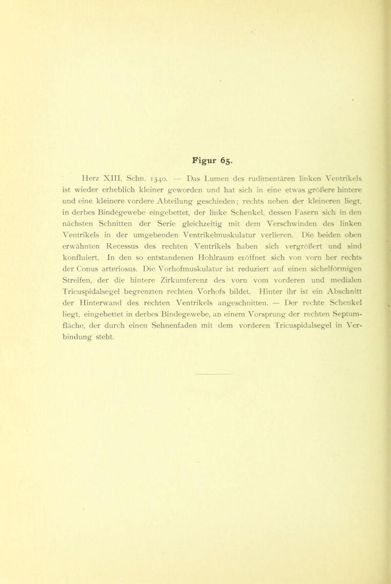 Merz Xni, Schn. 1340. — Das Lumen des rudimentären linken Ventrikels ist wieder erheblich kleiner geworden und hat sich in eine etwas größere hintere und eine kleinere vordere Abteilung geschieden; rechts neben der kleineren liegt, in derbes Bindegewebe eingebettet, der linke Schenkel, dessen Fasern sich in den nächsten Schnitten der Serie gleichzeitig mit dem Verschwinden des linken ^entrikels in der umgebenden Ventrikelmuskulatur verlieren. Die beiden oben erwähnten Recessus des rechten Ventrikels haben sich vergrößert und sind konfluiert. In den so entstandenen Hohlraum eröffnet sich von vorn her rechts der Conus arteriosus. Die A'orhofmuskulatur ist reduzien auf einen sichelförmigen Streifen, der die hintere Zirkumferenz des vorn vom vorderen und medialen Tricuspidalsegel begrenzten rechten Vorhofs bildet. Hinter ihr ist ein Abschnitt der Hinterwand des rechten Ventrikels angeschnitten. — Der rechte Schenkel liegt, eingebettet in derbes Bindegewebe, an einem Vorsprung der rechten Septum- fläche, der durch einen Sehnenfaden mit dem vorderen Tricuspidaksegel in Ver- bindung steht.