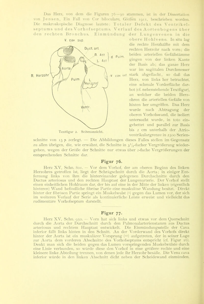 R. Herzohr (j Puirn. V cav inf Das Herz, von dom die Fieren 76—90 stammen, ist in der Dissertation von Jensen, Kin Fall von Cor biloculare, (ließen 1911, beschrieb«*n worden. Die makroskopische Diagnose lautete: Totaler Defekt des Ventrikel- septums und desN-orhofseptums. erlauf des.Aortenbogens über den rechten Jironchus. Fünmündung der Lungenvenen in die V cav sup obere Ilohlvene. In situ lag die rechte Herzhälfte mit dem rechten Herzohr nach vorn; die beiden arteriellen Gefäßstämme gingen von der linken Kante der Biisis ab; das ganze Herz war im sagittalen Durchmesser stark abgeflacht, so daß d.is Plerz, von links her betrachtet, eine schmale A’orderfläche dar- bot (cf. nebenstehende Textfigur), an welcher die beiden Herz- ohren die arteriellen Gefäße von hinten herumgriffen. Das Herz wurde nach Abtragung der oberen A'orhofswand, die isoliert untersucht wurde, in toto ein- gebettet und parallel zur Basis bis 2 cm unterhalb der Atrio- ventrikulargrenze in 2300 Serien- schnitte von 15 |j, zerlegt. — Die Abbildungen dieses Falles stellen im Gegensatz zu allen übrigen, die, wie erwähnt, die Schnitte in 3V2-facher Vergrößerung wieder- geben, wegen der Größe der Schnitte nur etwas über 2-fache A'ergrößerungen der entsprechenden Schnitte dar. Textfigur 2. Seitenansicht. Figur 76. Flerz XV, Schn. 801. — ^'^or dem Vorhof, der am oberen Beginn des linken Flerzohres getroffen ist, liegt der Schrägschnitt durch die Aorta; in einiger Ent- fernung links von ihm die hintereinander gelegenen Durchschnitte durch den Ductus arteriosus und den rechten Flauptast der Lungenarterie. Der A'orhof stellt einen einheitlichen Hohlraum dar, der bis auf eine in der Mitte der linken (eigentlich hinteren) Wand befindliche fibröse Partie eine muskulöse Wandung besitzt. Direkt hinter der fibrösen Partie springt ein ]\Iuskelwulst (x) gegen das Lumen vor, der sich im weiteren Verlauf der Serie als kontinuierliche Leiste erweist und vielleicht das rudimentäre Vorhofseptum darstellt. Figur 77. I lerz XV, Schn. 950. — \'orn hat sich links und etwas vor dem Querschnitt durch die Aorta der IXirchschnitt durch den Pulmonalarterienstamm aus Ductus arteriosus und rechtem Hauptast entwickelt. Die Einmündungsstelle der Cava inferior fällt links hinten in den Schnitt. .Vn der A^'orderwand des Vorhofs direkt hinter der Aorta ist ein muskulärer \orsprung (xx) aufgetreten, der in seiner Lage zur Aorta dem vorderen Abschnitte des Vorhofseptums entspricht (cf. Figur 16). Denkt man sich die beiden gegen das Lumen vorspringenden Muskelwülste durcli eine Linie verbunden, so würde diese den A'orhof in eine größere rechte und eine kleinere linke Abteilung trennen, von denen jede ihr 1 lerzohr be.säße. Die Vena cava inferior würde in den linken Abschnitt dicht neben der Scheidewand einmünden.