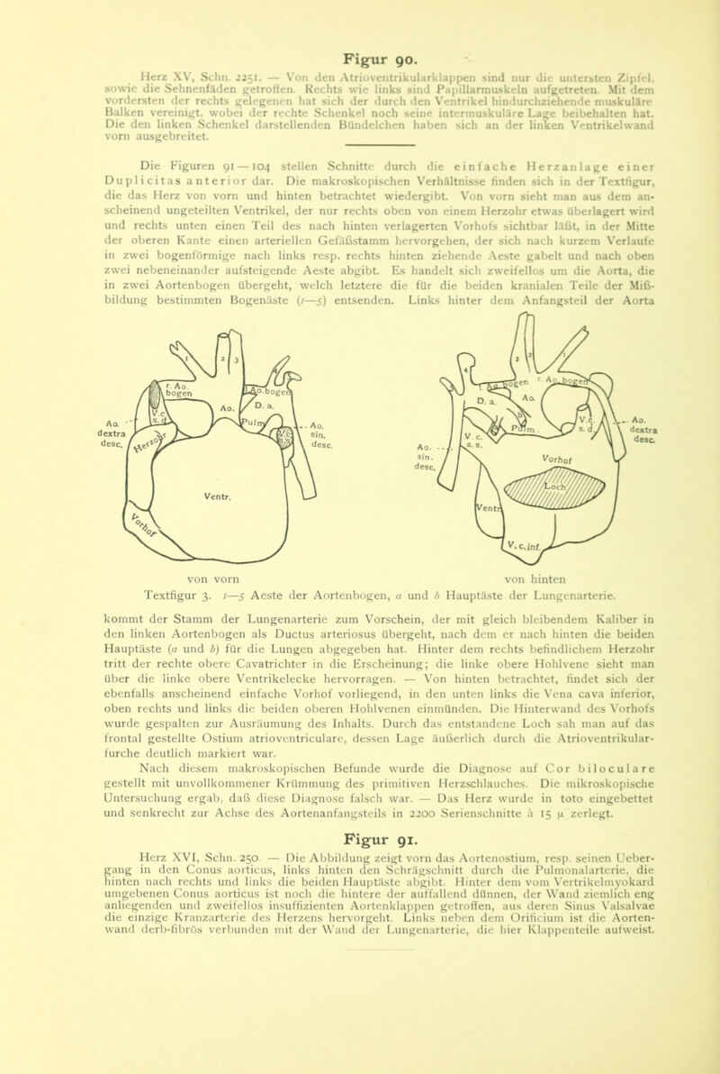 Herz XV, Schn. 2251. — V’on den Atrioventrikularklappen sind nur die untersten Zipfel, sowie die Sehnenfäden getroffen. Rechts wie links sind Fapillarmuskeln aufgetreten. .Mit dem vordersten der rechts gelegenen hat sich der durch den Ventrikel hindurcliziehende muskuläre Balken vereinigt, wobei der rechte Schenkel noch seine intermuskuläre La« beibehalten hat. Die den linken Schenkel darstellenden Bündelchen haben sich an der linken Ventrikelwand vorn ausgebreitet. Die Figuren 91 — 104 stellen Schnitte durch die einfache Herzanlage einer Duplicitas anterior dar. Die makroskopischen Verhältnisse finden sich in der Textfigur, die das Herz von vorn und hinten betrachtet wiedergibt. Von vorn sieht man aus dem an- scheinend ungeteilten Ventrikel, der nur rechts oben von einem Herzohr etwas überlagert wird und rechts unten einen Teil des nach hinten verlagerten V’orhofs sichtbar läßt, in der .Mitte der oberen Kante einen arteriellen Gefäßstamm hervorgehen, der sich nach kurzem Verlaufe in zwei bogenförmige nach links resp. rechts hinten ziehende Aeste gabelt und nach oben zwei nebeneinander aufsteigende Aeste abgibt. Es handelt sich zweifellos um die .Aorta, die in zwei Aortenbogen übergeht, welch letztere die für die beiden kranialen Teile der Miß- bildung bestimmten Bogenäste (/—5) entsenden. Links hinter dem Anfangsteil der Aorta Textfigur 3. /—5 Aeste der Aortenbogen, a und b Hauptäste der Lungenarterie. kommt der Stamm der Lungenarterie zum Vorschein, der mit gleich bleibendem Kaliber in den linken Aortenbogen als Ductus arteriosus übergeht, nach dem er nach hinten die beiden Hauptäste (a und b) für die Lungen abgegeben hat. Hinter dem rechts befindlichem Herzohr tritt der rechte obere Cavatrichter in die Erscheinung; die linke obere Hohlvene sieht man über die linke obere Ventrikelecke hervorragen. — Von hinten betrachtet, findet sich der ebenfalls anscheinend einfache Vorhof vorliegend, in den unten links die Vena cava inferior, oben rechts und links die beiden oberen Hohlvenen einmünden. Die Hinterwand des Vorhofs wurde gespalten zur Ausräumung des Inhalts. Durch das entstandene Loch sah man auf das frontal gestellte Ostium atrioventriculare, dessen Lage äußerlich durch die Atrioventrikular- furche deutlich markiert war. Nach diesem makroskopischen Befunde wurde die Diagnose auf Cor biloculare gestellt mit unvollkommener Krümmung des primitiven Herzschlauches. Die mikroskopisclie Untersuchung ergab, daß diese Diagnose falsch war. — Das Herz wurde in toto eingebettet und senkrecht zur Achse des Aortenanfangsteils in 2200 Serienschnitte ä 15 zerlegt. Figur 91. Herz XVI, Schn. 250. — Die Abbildung zeigt vorn das Aortenostium, resp. seinen Ueber- gang in den Conus aorticus, links hinten den Schrägschnitt durch die Pulmonalarterie, die hinten nach rechts und links die beiden Hauptäste abgibt. Hinter dem vom Vertrikelmyokard umgebenen Conus aorticus ist noch die hintere der auffallend dünnen, der Wand ziemlich eng anliegenden und zweifellos insuffizienten Aortenklappen getroffen, aus deren Sinus Valsalvae die einzige Kranzarterie des Herzens hervorgeht. Links neben dem Ürificium ist die Aorten- wand derb-fibrös verbunden mit der Wand der Lungenarterie, die hier Klappenteile aufweist.