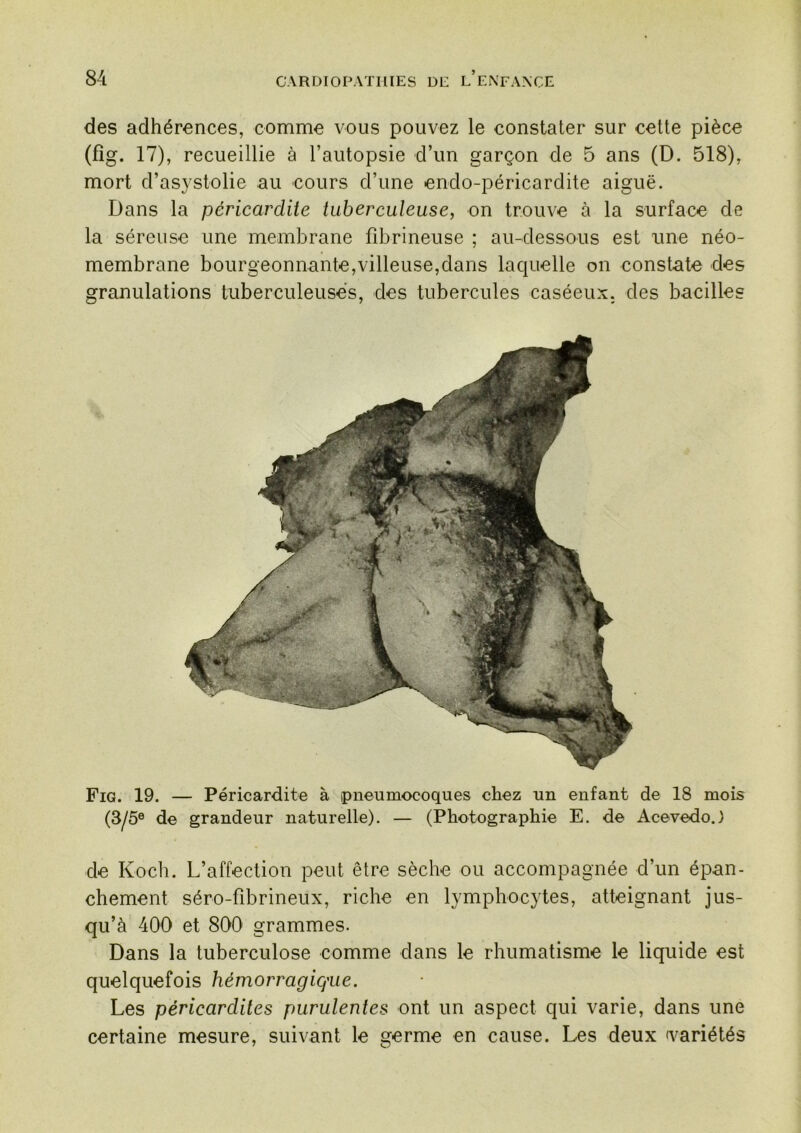 des adhérences, comme vous pouvez le constater sur cette pièce (fîg. 17), recueillie à l’autopsie d’un garçon de 5 ans (D. 518), mort d’asystolie au cours d’une endo-péricardite aiguë. Dans la péricardite tuberculeuse, on trouve à la surface de la séreuse une membrane fibrineuse ; au-dessous est une néo- membrane bourgeonnante,villeuse,dans laquelle on constate des granulations tuberculeuses, des tubercules caséeux, des bacilles Fig. 19. — Péricardite à pneumocoques chez un enfant de 18 mois (3/5® de grandeur naturelle). — (Photographie E. de Acevedo.) de Koch. L’affection peut être sèche ou accompagnée d’un épan- chement séro-fibrineux, riche en lymphocytes, atteignant jus- qu’à 400 et 800 grammes. Dans la tuberculose comme dans le rhumatisme le liquide est quelquefois hémorragique. Les péricardites purulentes ont un aspect qui varie, dans une certaine mesure, suivant le germe en cause. Les deux q^ariétés
