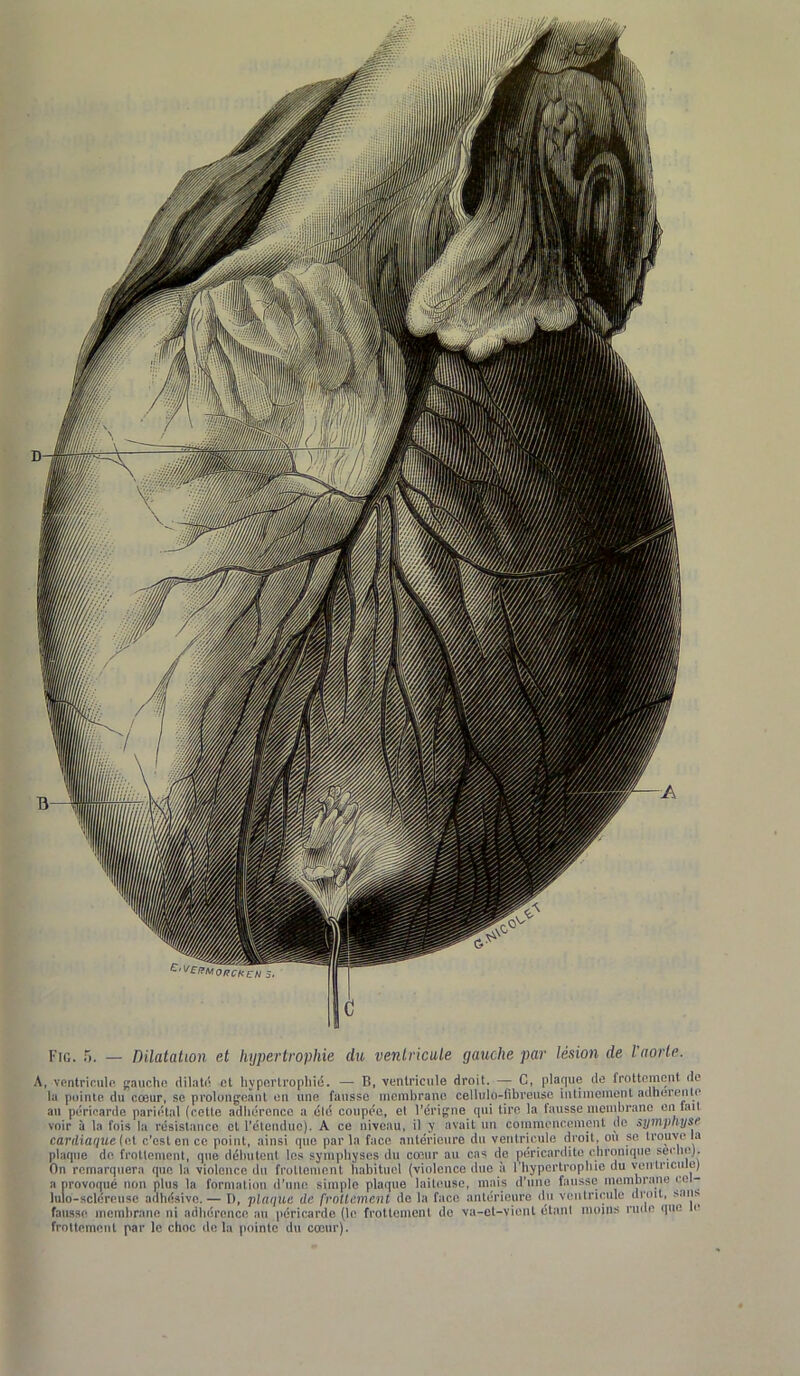 Fig. 5. — Dilatation et hypertrophie du ventricule gauche par lésion de Vaorte. A, ventricule, gauche dilaté et hypertrophié. — B, ventricule droit. — C, plaque de frottement de la pointe du cœur, se prolongeant en une fausse membrane c el lu 1 o-fi b reuse intimement adhérente au péricarde pariétal (cotte adhérence a élé coupée, et l’érigne qui tire la fausse membrane en fait voir à la fois la résistance et l'étendue). A ce niveau, il y avait un commencement de symphyse cardiaque (et c’cst en ce point, ainsi que parla face antérieure du ventricule droit, on se trouve la plaque de frottement, que débutent les symphyses du coiur au cas de péricardite chronique serbe). On remarquera que la violence du frottement habituel (violence due à l’hypertrophie du ventricule) a provoqué non plus la formation d’une simple plaque laiteuse, mais d’une fausse membrane ce - lulo-scléreuse adhésive. — D, plaque de frottement de la face antérieure du ventricule droit, sans fausse membrane ni adhérence au péricarde (le frottement de va-et-vient étant moins rude que le frottement par le choc do la pointe du cœur).