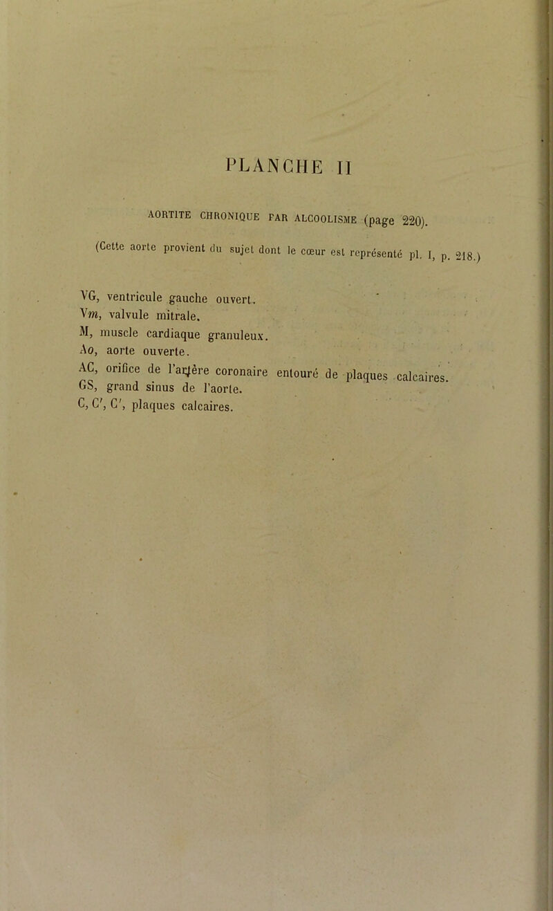 AORTITE CHRONIQUE FAR ALCOOLISME (page 220). (Cette aorte provient du sujet dont le coeur est représenté pl. I, p. 218.) VG, ventricule gauche ouvert. Vm, valvule mitrale. M, muscle cardiaque granuleux. Ao, aorte ouverte. AC, orifice de lacère coronaire entouré de plaques calcaires. GS, grand sinus de l’aorte. C, G', C', plaques calcaires.