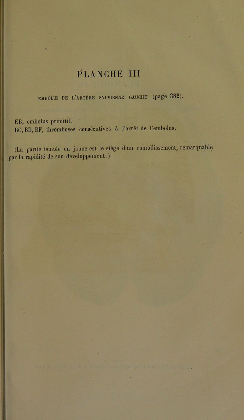 embolie de l’artère sylvienne gauche (page 382). EB, embolus primitif. BG, BD, BF, thromboses consécutives à l’arrêt de l’embolus. (La partie teintée en jaune est le siège d’un ramollissement, remarquable par la rapidité de son développement.)
