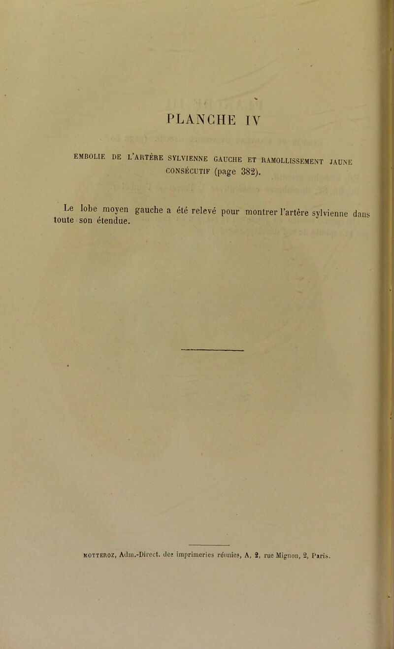 EMBOLIE DE L’ARTÈBE SYLVIENNE OADCIIE ET RAMOLLISSEMENT JAUNE consécutif (page 382). Le lobe moyen gauche a été relevé pour montrer l’artère sylvienne dans toute son étendue. kotteroz, Adm.-Direct. des imprimeries réunies, A, 2, rue Mignon, 2, Paris.