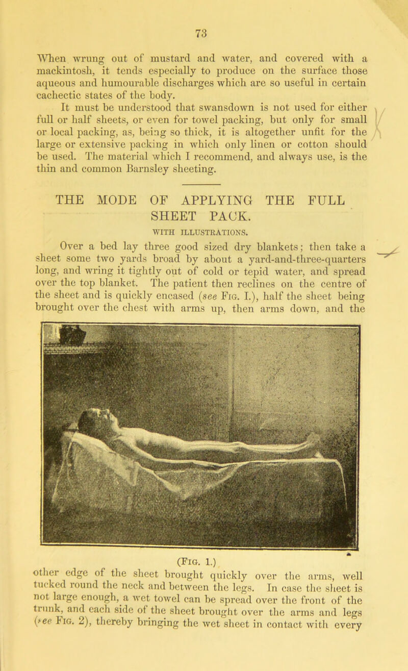 When wrung out of mustard and water, and covered with a mackintosh, it tends especially to produce on the surface those aqueous and humourable discharges which are so useful in certain cachectic states of the body. It must be understood that swansdown is not used for either full or half sheets, or even for towel packing, but only for small or local packing, as, being so thick, it is altogether unfit for the large or extensive packing in which only linen or cotton should be used. The material which I recommend, and always use, is the thin and common Barnsley sheeting. THE MODE OF APPLYING THE FULL SHEET PACK. WITH ILLUSTRATIONS. Over a bed lay three good sized dry blankets; then take a sheet some two yards broad by about a yard-and-three-quarters long, and wring it tightly out of cold or tepid water, and spread over the top blanket. The patient then reclines on the centre of the sheet and is quickly encased (see Fig. I.), half the sheet being brought over the chest with arms up, then arms down, and the (Fig. 1.) other edge of the sheet brought quickly over the arms, well tucked round the neck and between the legs. In case the sheet is not large enough, a wet towel can be spread over the front of the trunk, and each side of the sheet brought over the arms and legs (fee Iig. 2), thereby bringing the wet sheet in contact with every