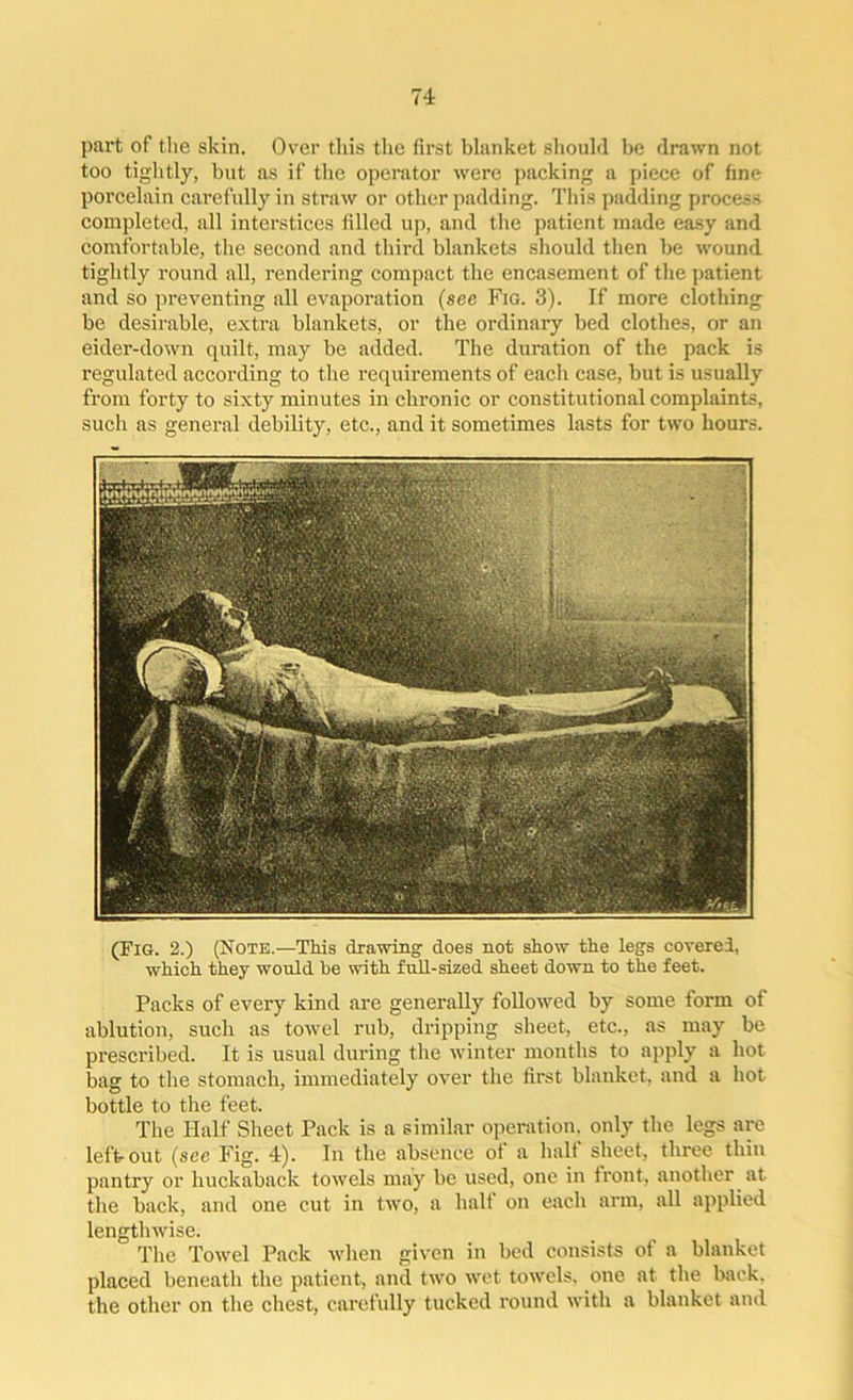 part of the skin. Over this the first blanket should be drawn not too tightly, but as if the operator were packing a piece of fine porcelain carefully in straw or other padding. This padding process completed, all interstices filled up, and the patient made easy and comfortable, the second and third blankets should then be wound tightly round all, rendering compact the encasement of the patient and so preventing all evaporation (see Fig. 3). If more clothing be desirable, extra blankets, or the ordinary bed clothes, or an eider-down quilt, may be added. The duration of the pack is regulated according to the requirements of each case, but is usually from forty to sixty minutes in chronic or constitutional complaints, such as general debility, etc., and it sometimes lasts for two hours. (Fig. 2.) (Note.—This drawing- does not show the legs covered, which they would be with full-sized sheet down to the feet. Packs of every kind are generally followed by some form of ablution, such as towel rub, dripping sheet, etc., as may be prescribed. It is usual during the winter months to apply a hot bag to the stomach, immediately over the first blanket, and a hot- bottle to the feet. The Half Sheet Pack is a similar operation, only the legs are left out (see Fig. 4). In the absence of a half sheet, three thin pantry or huckaback towels may be used, one in front, another at the back, and one cut in two, a half on each arm, all applied lengthwise. The Towel Pack when given in bed consists of a blanket placed beneath the patient, and two wet towels, one at the back, the other on the chest, carefully tucked round with a blanket and