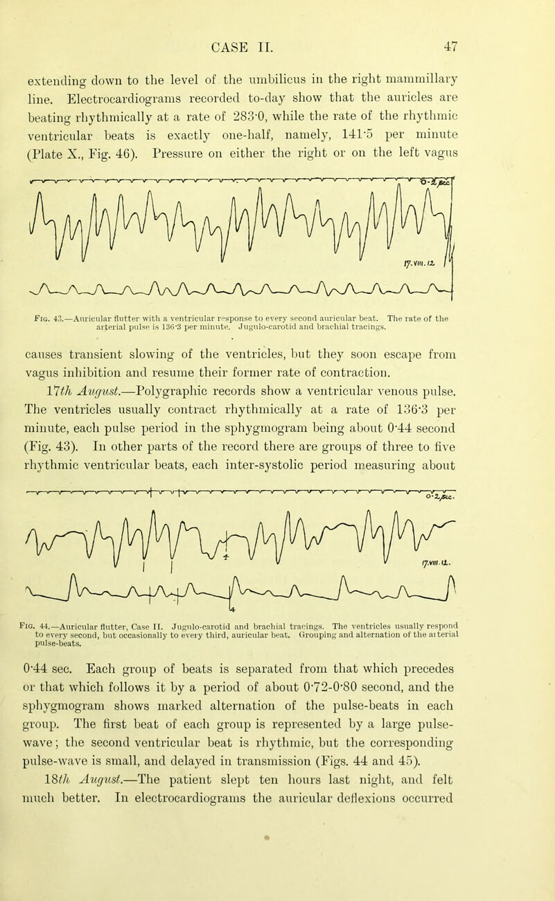 extending down to the level of the nnibilicus in the right maininillaiy line. Electrocardiograms recorded to-day show that the auricles are beating rhythmically at a rate of 283'0, while the rate of the rhythmic ventricnlar beats is exactly one-half, namely, 141'5 per minute (Plate X., Fig. 46). Pressure on either the right or on the left vagus Fig. 4.3.—Auricular flutter witli a ventricular response to every second auricular beat. Tlie rate of tlie arterial pulse is 136‘3 per minute. Jugulo-carotid and brachial tracings. causes transient slowing of the ventricles, but they soon escape from vagus inhibition and resume their former rate of contraction. VWi August.—Polygraphic records show a ventricular venous pulse. The ventricles usually contract rhythmically at a rate of 136'3 per minute, each pulse period in tlie sphygmogram being about 0'44 second (Fig. 43). In other parts of the record there are groups of three to live rhythmic ventricular beats, each inter-systolic period measuring about Fig. 44.—Auricular flutter, Case II. Jugnlo-carotid and brachial tracings. The ventricles usually respond to every second, but occasionally to every third, auricular beat. Grouping and alternation of the aiterial pulse-beats. 0'44 sec. Each group of beats is separated from that which precedes or that which follows it by a period of about 0'72-0’80 second, and the sphygmogram shows marked alternation of the pulse-beats in each group. The first beat of each group is represented by a large pulse- wave ; the second ventricular beat is rhythmic, but the corresponding pulse-wave is small, and delayed in transmission (Figs. 44 and 45). 18f/fc August.—The patient slept ten hours last night, and felt much better. In electrocardiograms the auricular deflexions occurred