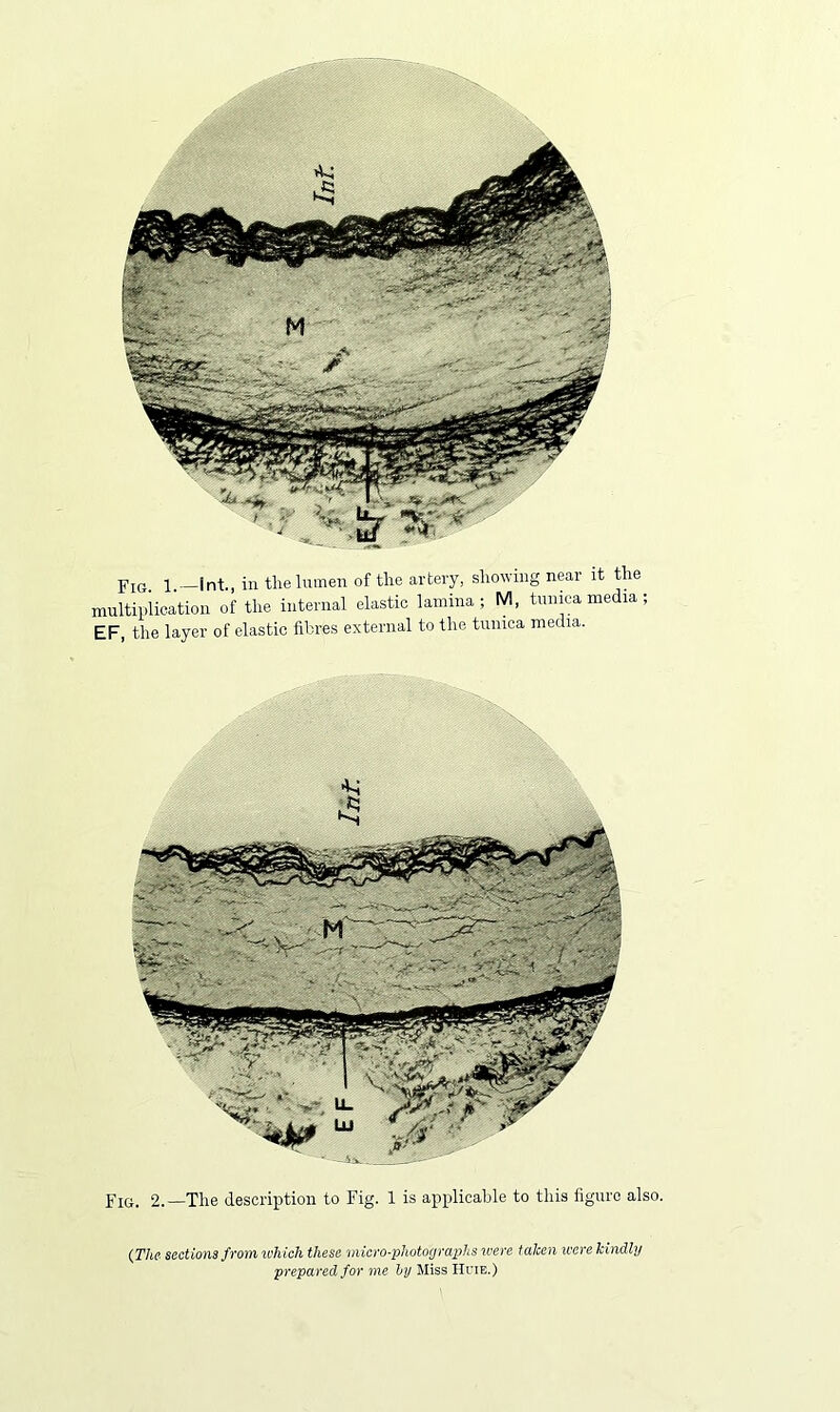multiplication of the internal elastic lamina; M, tunica media ; EF, the layer of elastic fibres external to the tunica media. Fig. 2.—The description to Fig. 1 is applicable to this figure also. {The- sections from u'hich these micro-photographs u'cre taken were kindly prepared for me hy Miss Hcie.)