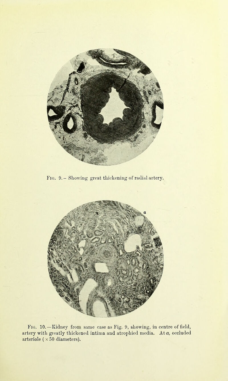 Fig. 9. - Showing great thickening of radial artery. Fig. 10.—Kidney from same case as Fig. 9, showing, in centre of field, artery with greatly thickened intima and atrophied media. At a, occluded arteriole ( x 50 diameters).