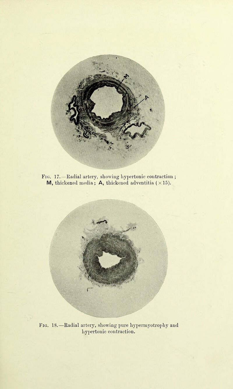 Fig. 17.—Kadial artery, showing hypertonic contraction ; M, thickened media ; A, thickened adventitia ( X 15). Fig. 18.—Radial artery, showing pure hypermyotrophy and hypertonic contraction.